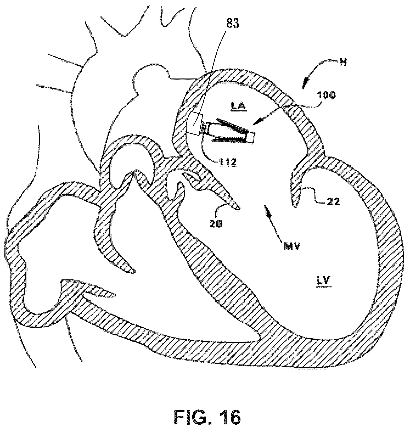 Patent US12396850 Figure 11 – Catheterization method and apparatus