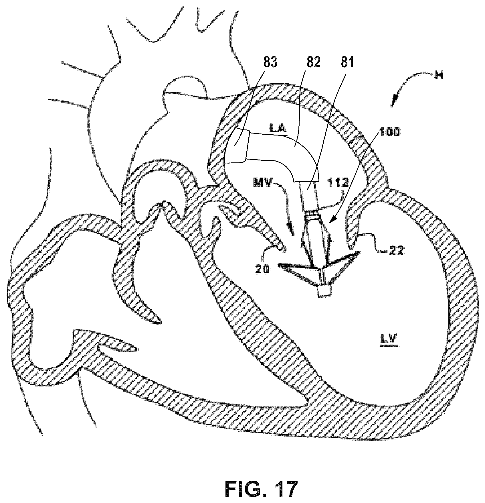 Patent US12396850 Figure 12 – Catheterization method and apparatus