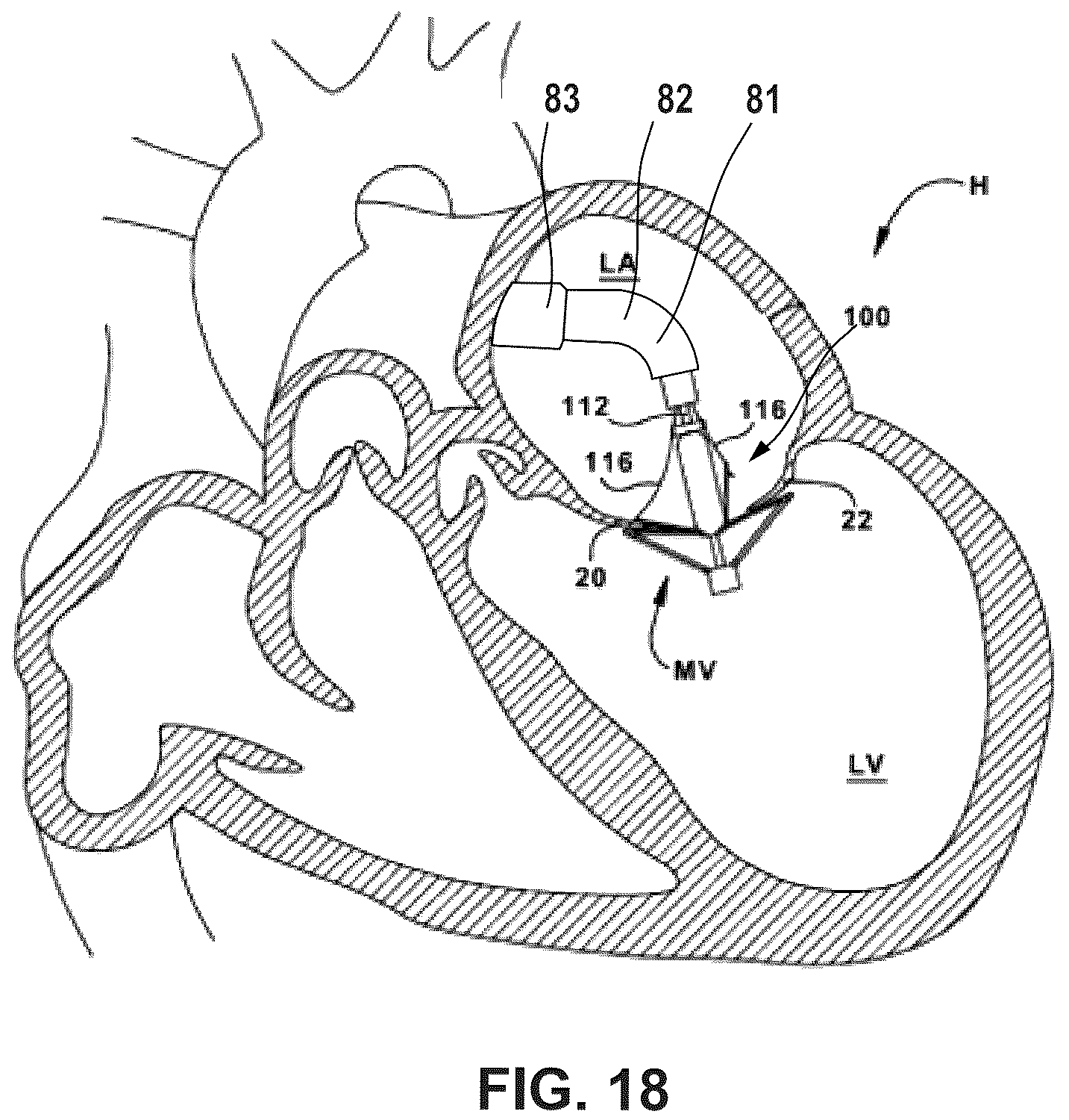 Patent US12396850 Figure 13 – Catheterization method and apparatus