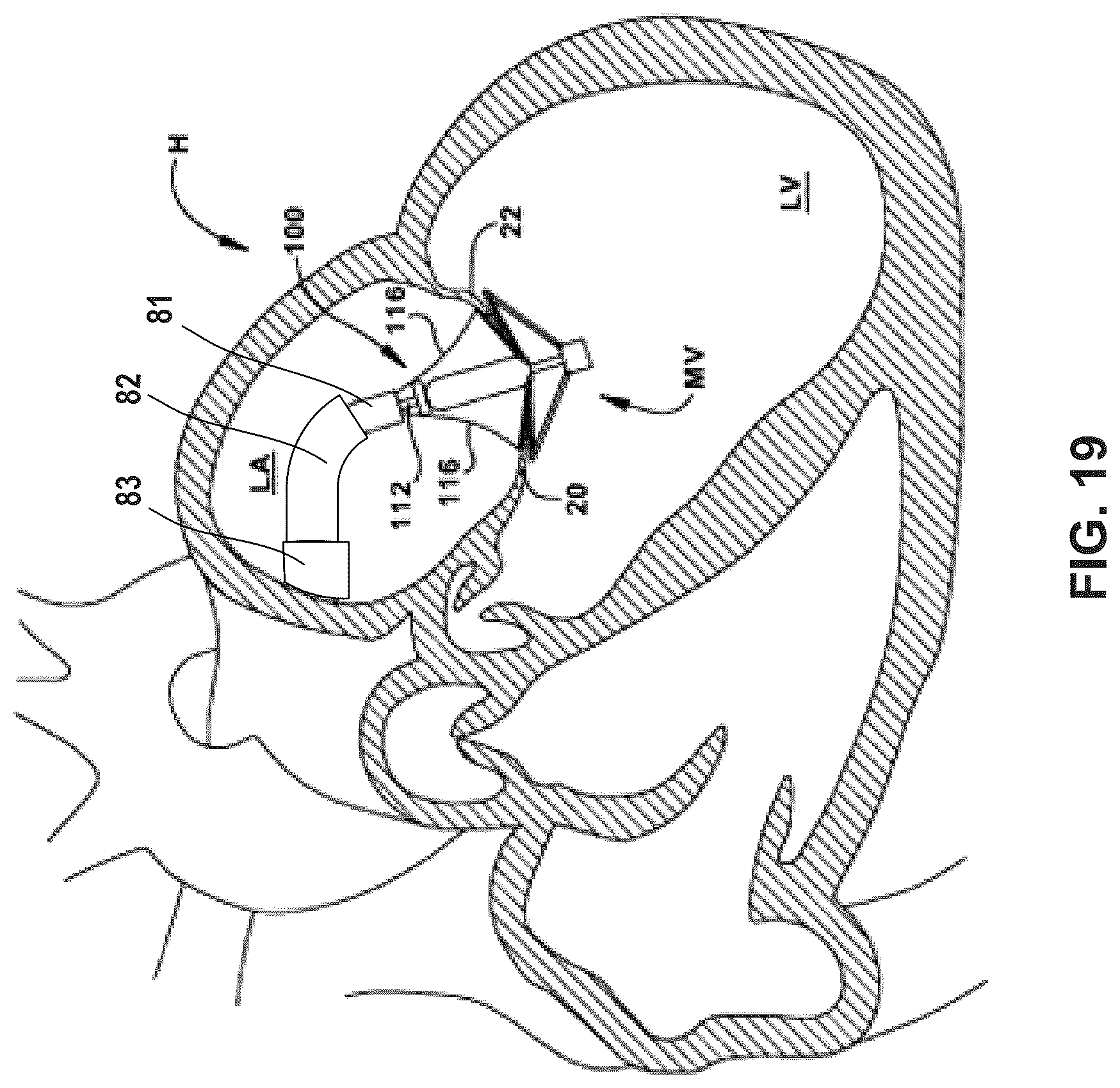 Patent US12396850 Figure 14 – Catheterization method and apparatus