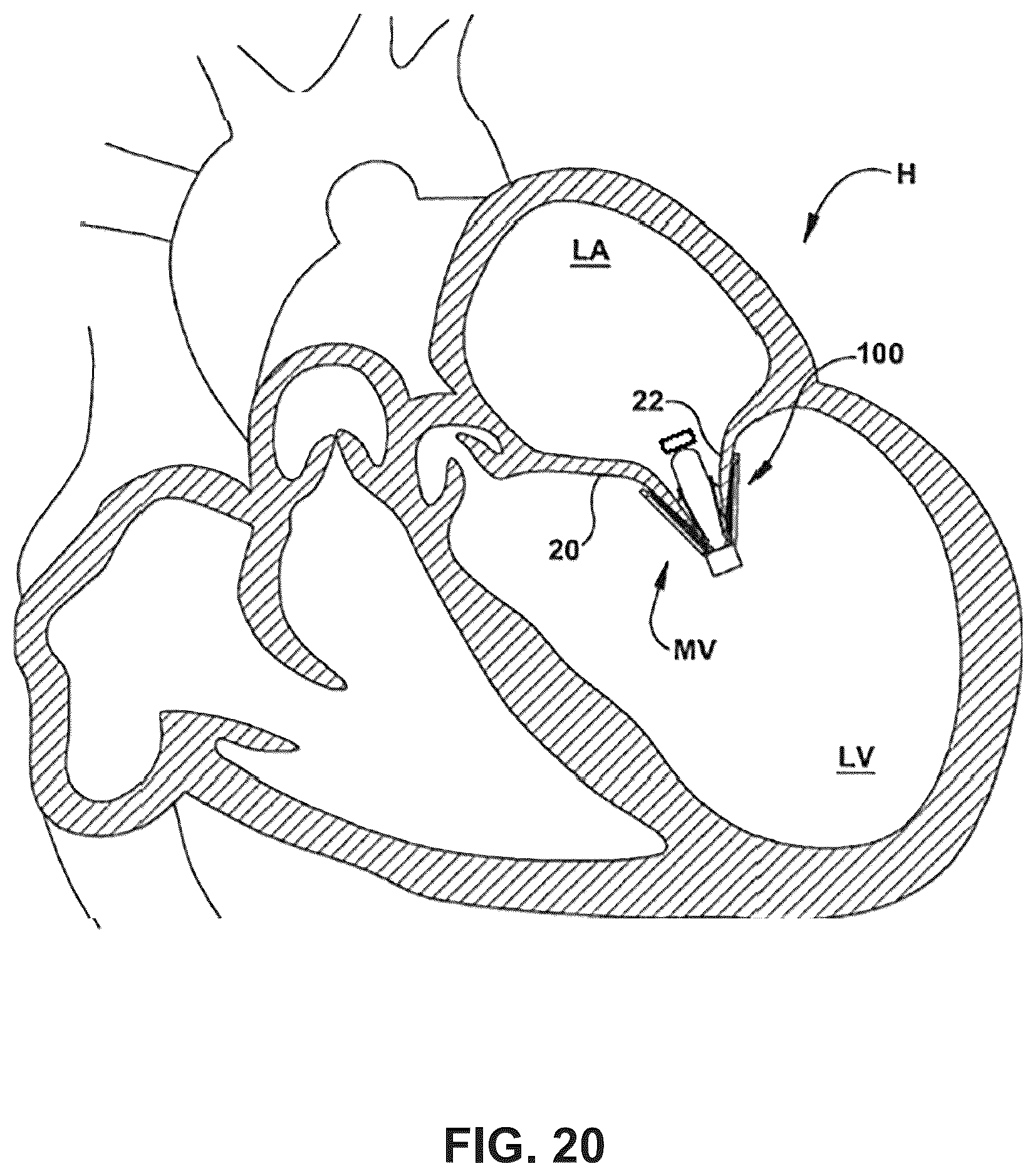 Patent US12396850 Figure 15 – Catheterization method and apparatus
