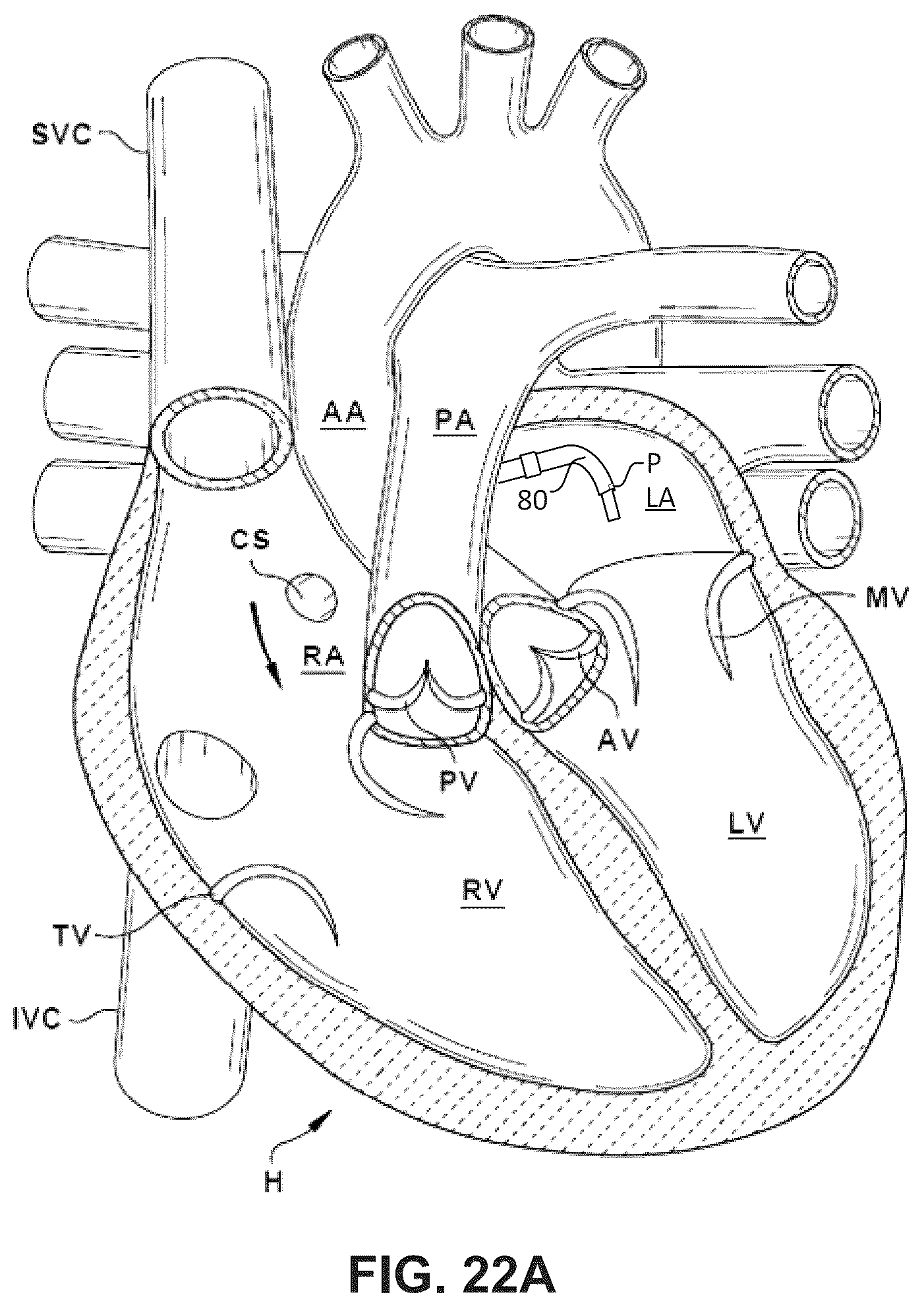 Patent US12396850 Figure 19 – Catheterization method and apparatus