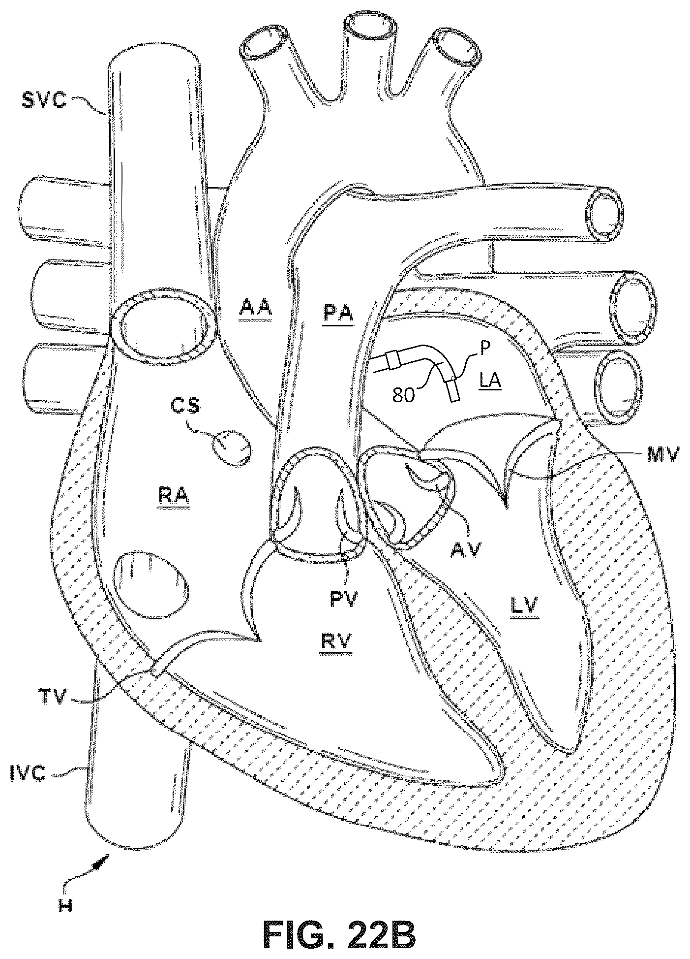 Patent US12396850 Figure 20 – Catheterization method and apparatus