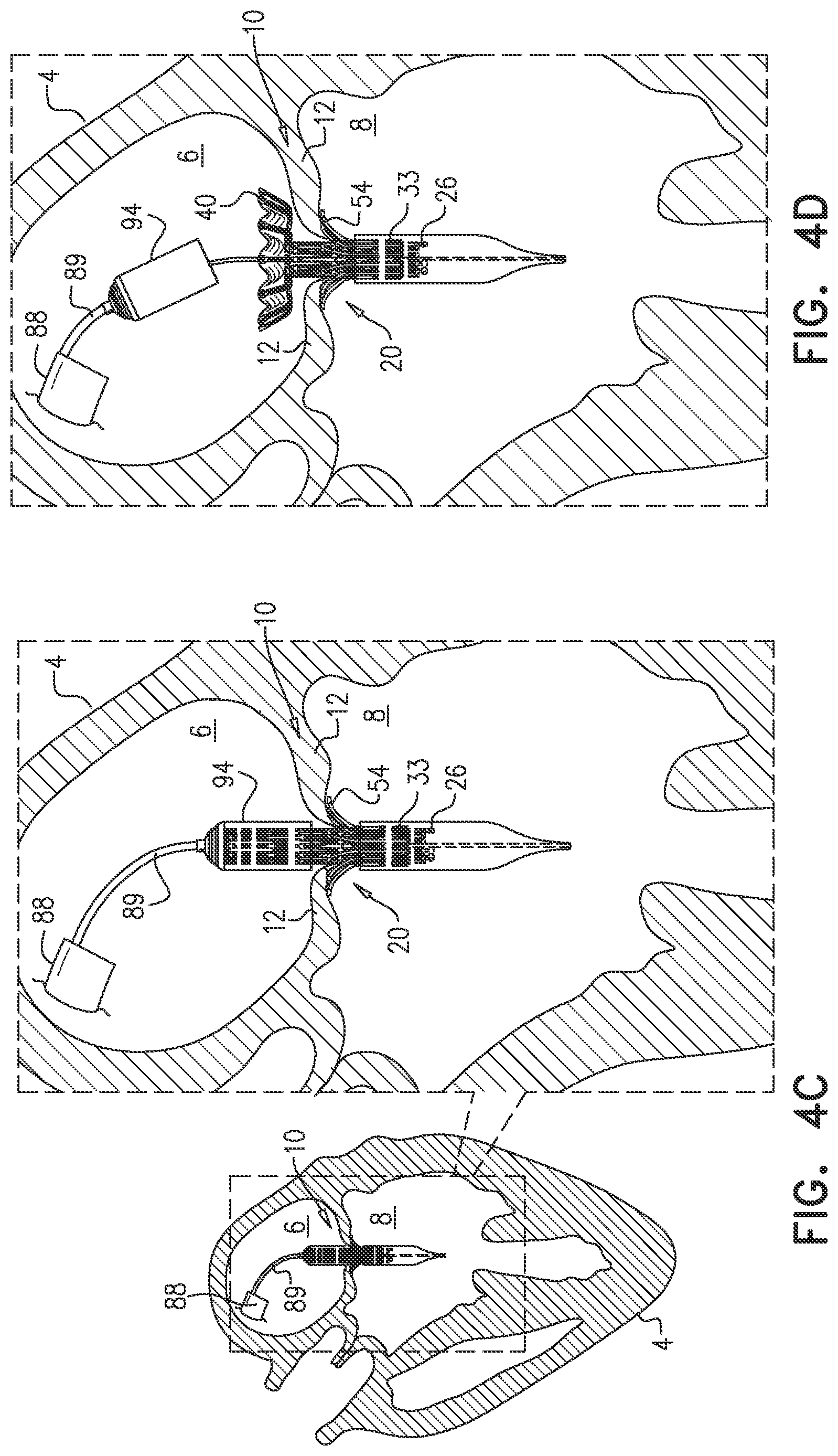 Patent US12396851 Figure 10 – Prosthetic valve with arms and flanges