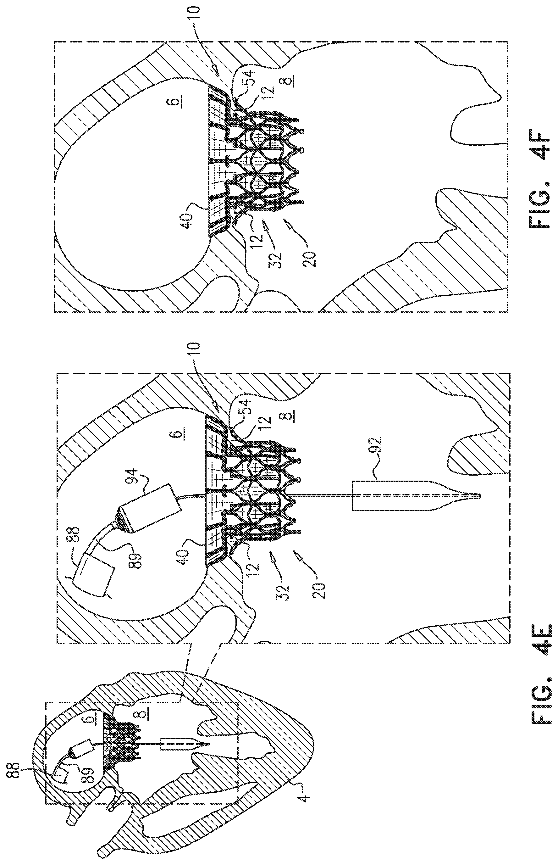 Patent US12396851 Figure 11 – Prosthetic valve with arms and flanges