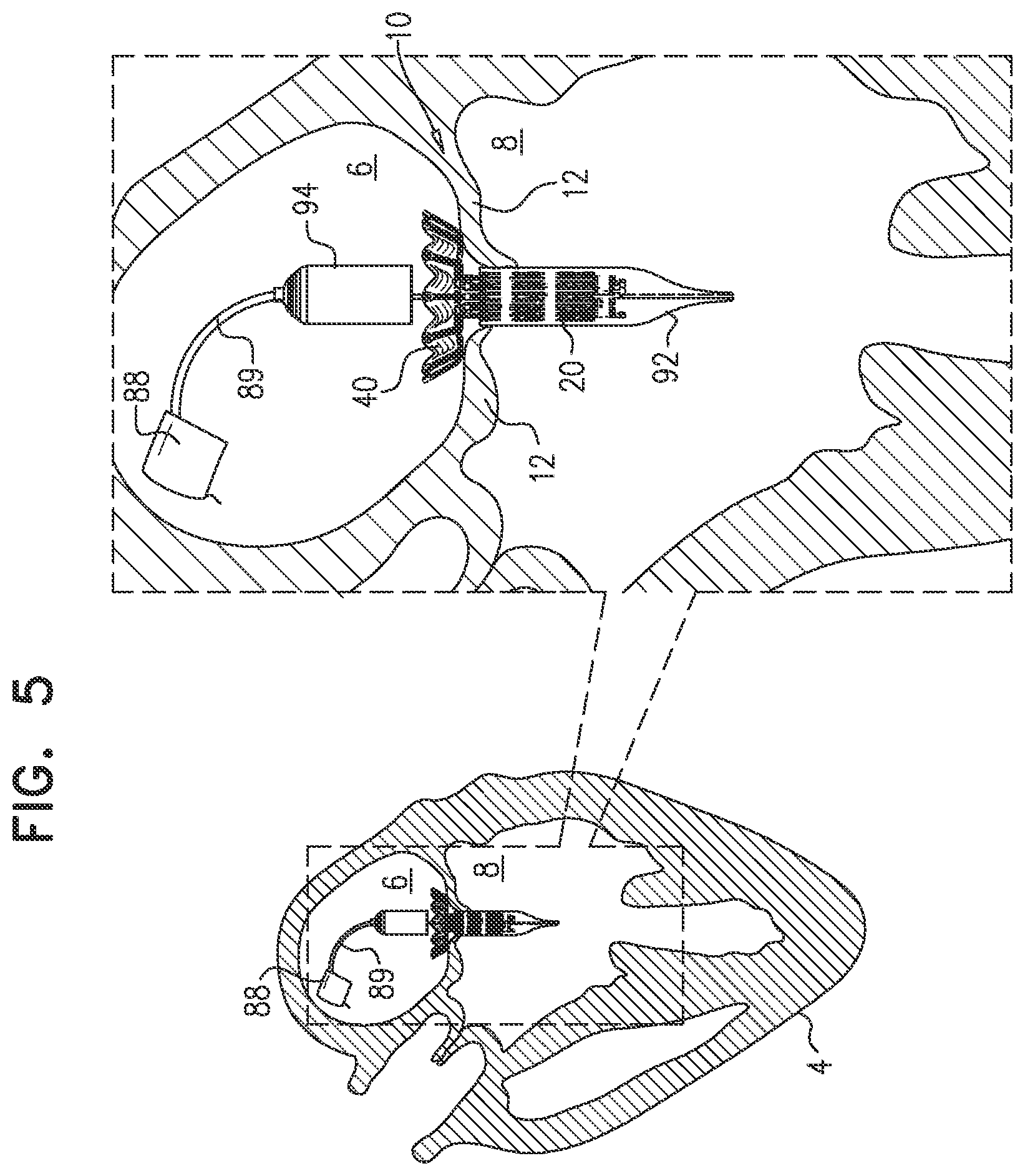 Patent US12396851 Figure 12 – Prosthetic valve with arms and flanges