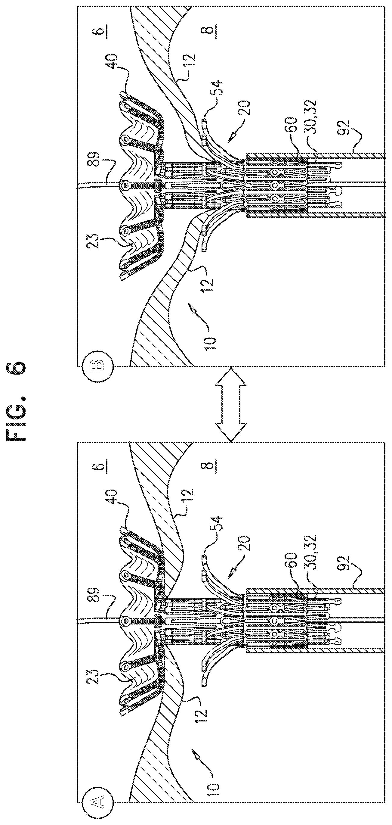 Patent US12396851 Figure 13 – Prosthetic valve with arms and flanges