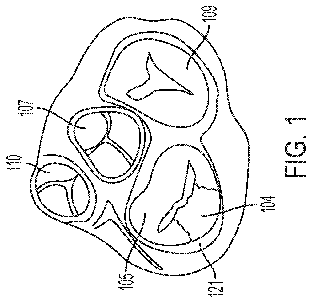 Patent US12396853 — Systems and methods for delivery of chordae replacement system — Figure 1