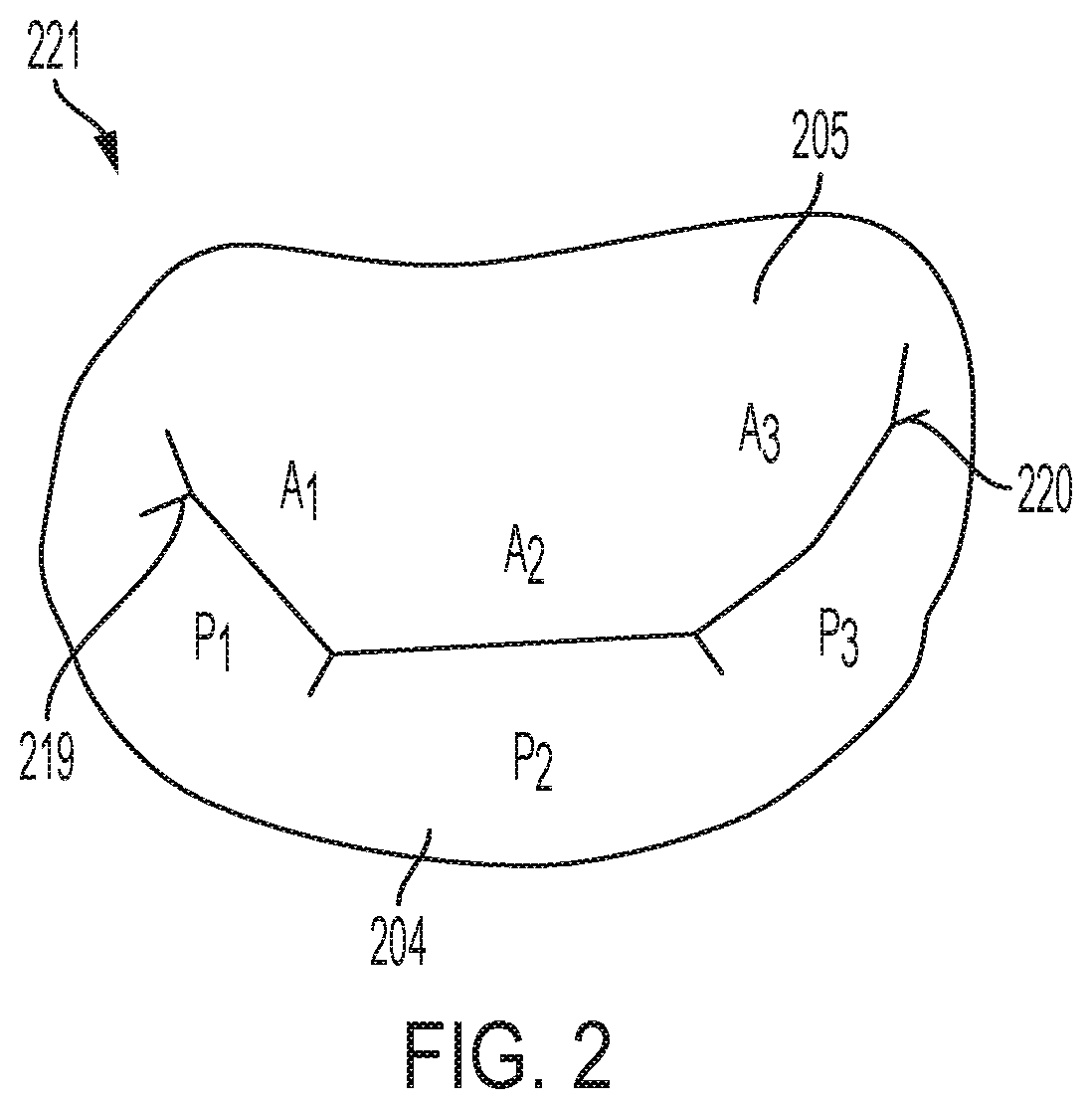 Patent US12396853 Figure 2 – Systems and methods for delivery of chordae replacement system