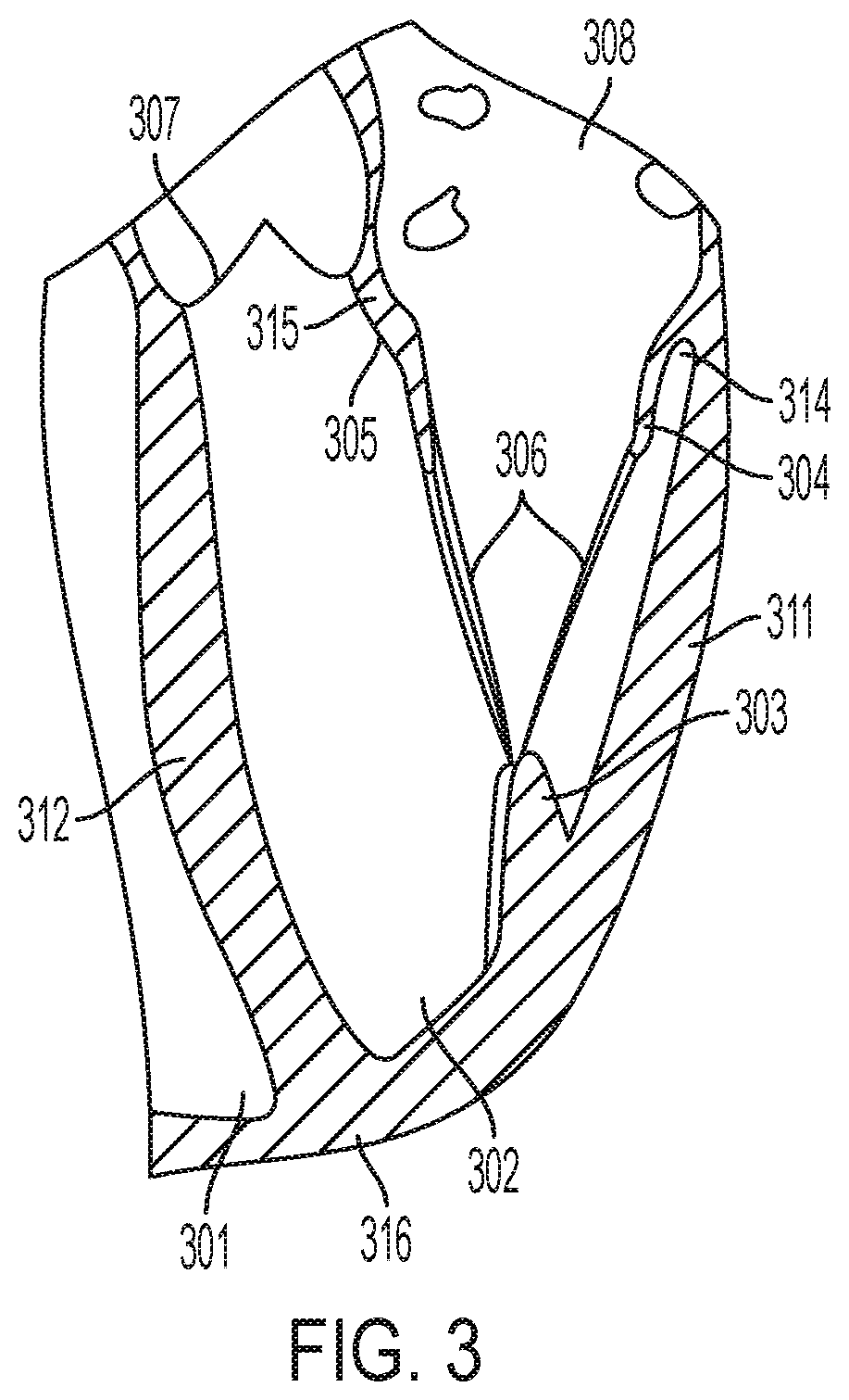 Patent US12396853 Figure 3 – Systems and methods for delivery of chordae replacement system