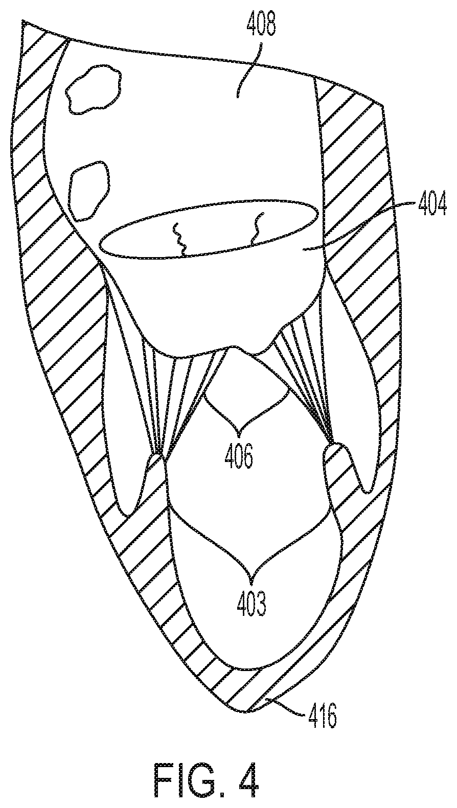 Patent US12396853 Figure 4 – Systems and methods for delivery of chordae replacement system