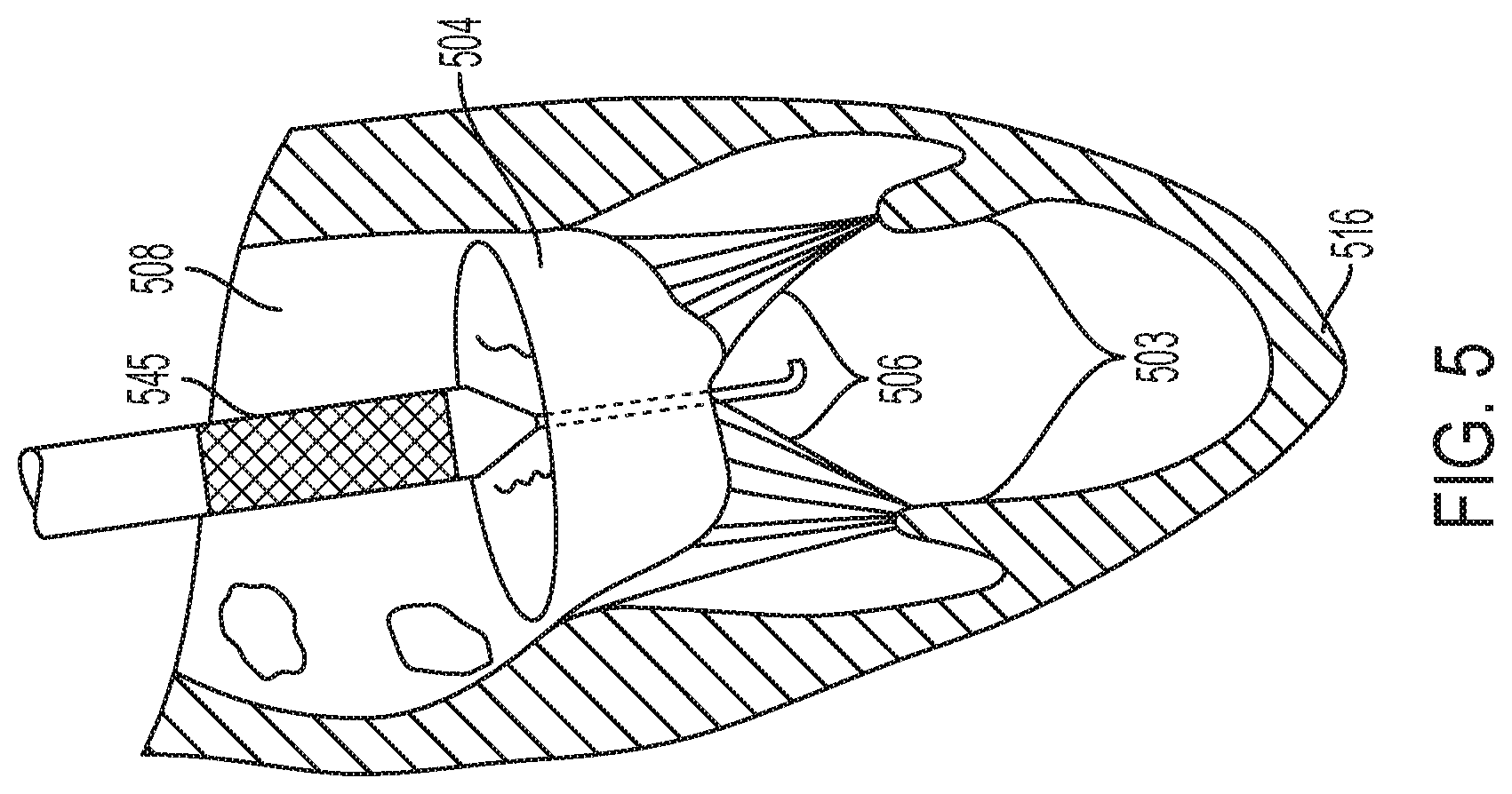 Patent US12396853 Figure 5 – Systems and methods for delivery of chordae replacement system