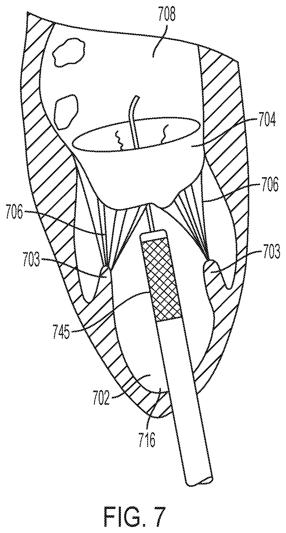 Patent US12396853 Figure 7 – Systems and methods for delivery of chordae replacement system