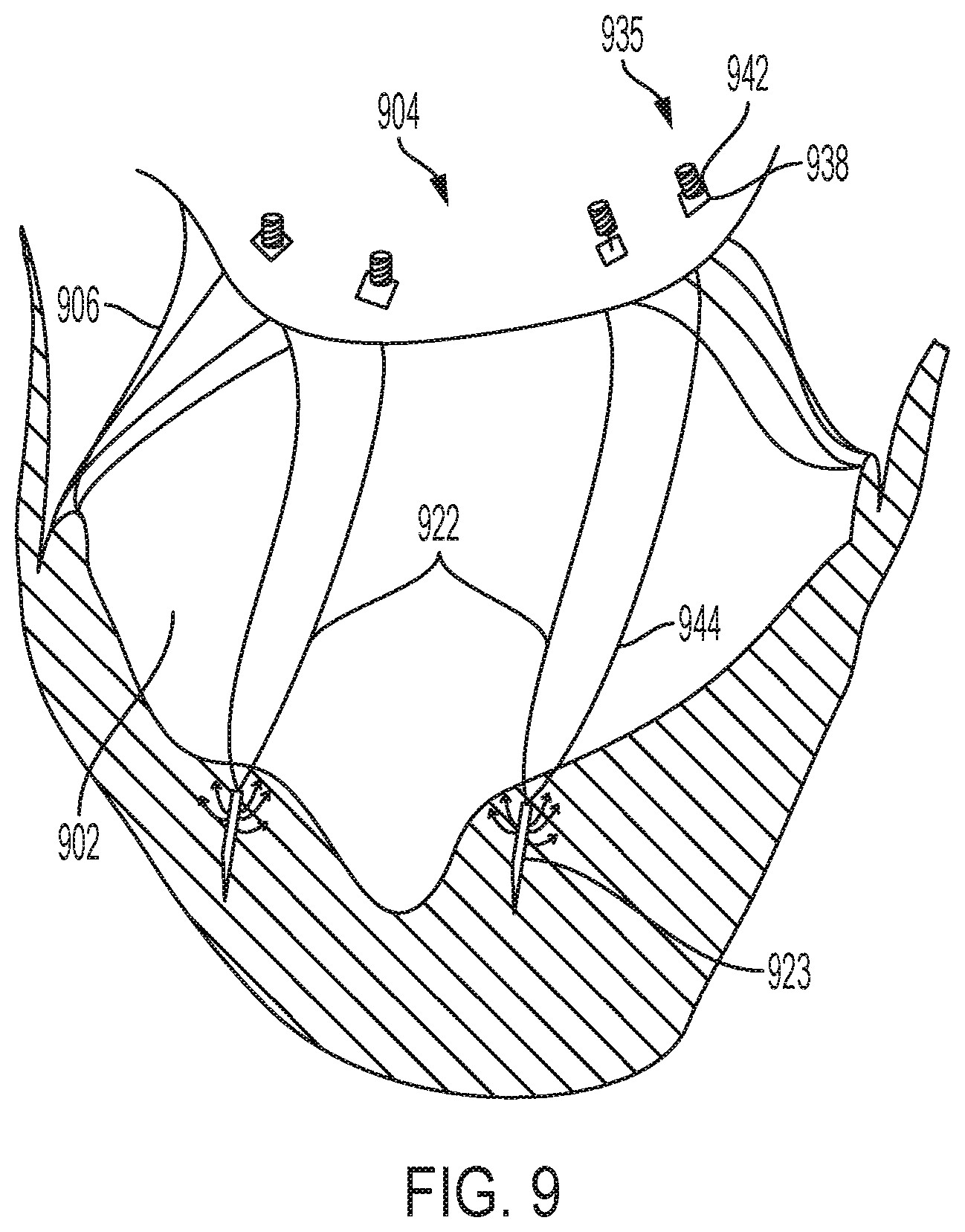 Patent US12396853 Figure 9 – Systems and methods for delivery of chordae replacement system