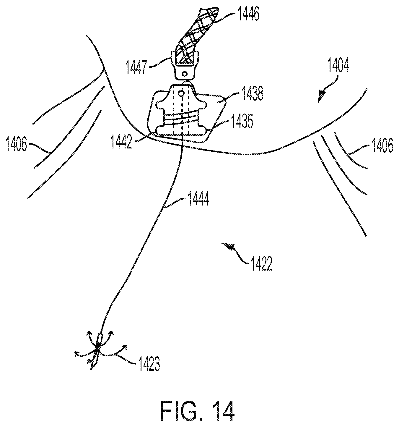 Patent US12396853 Figure 14 – Systems and methods for delivery of chordae replacement system