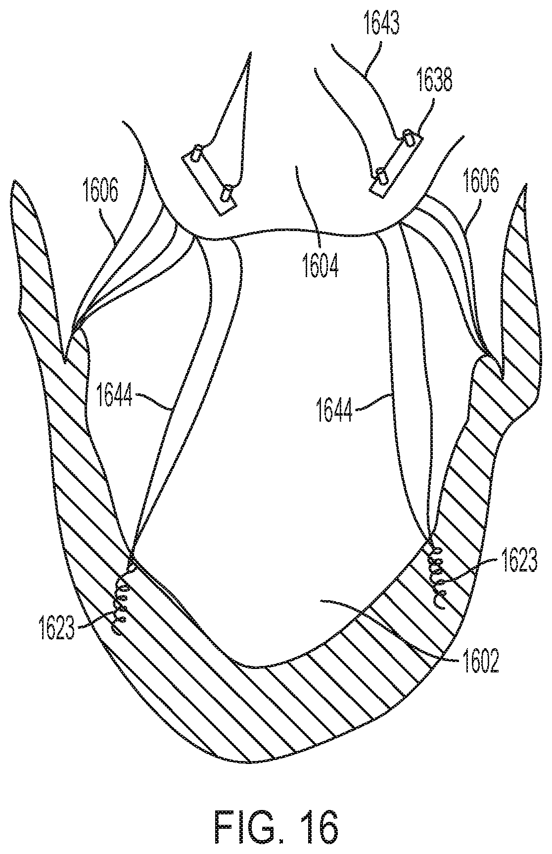 Patent US12396853 Figure 16 – Systems and methods for delivery of chordae replacement system