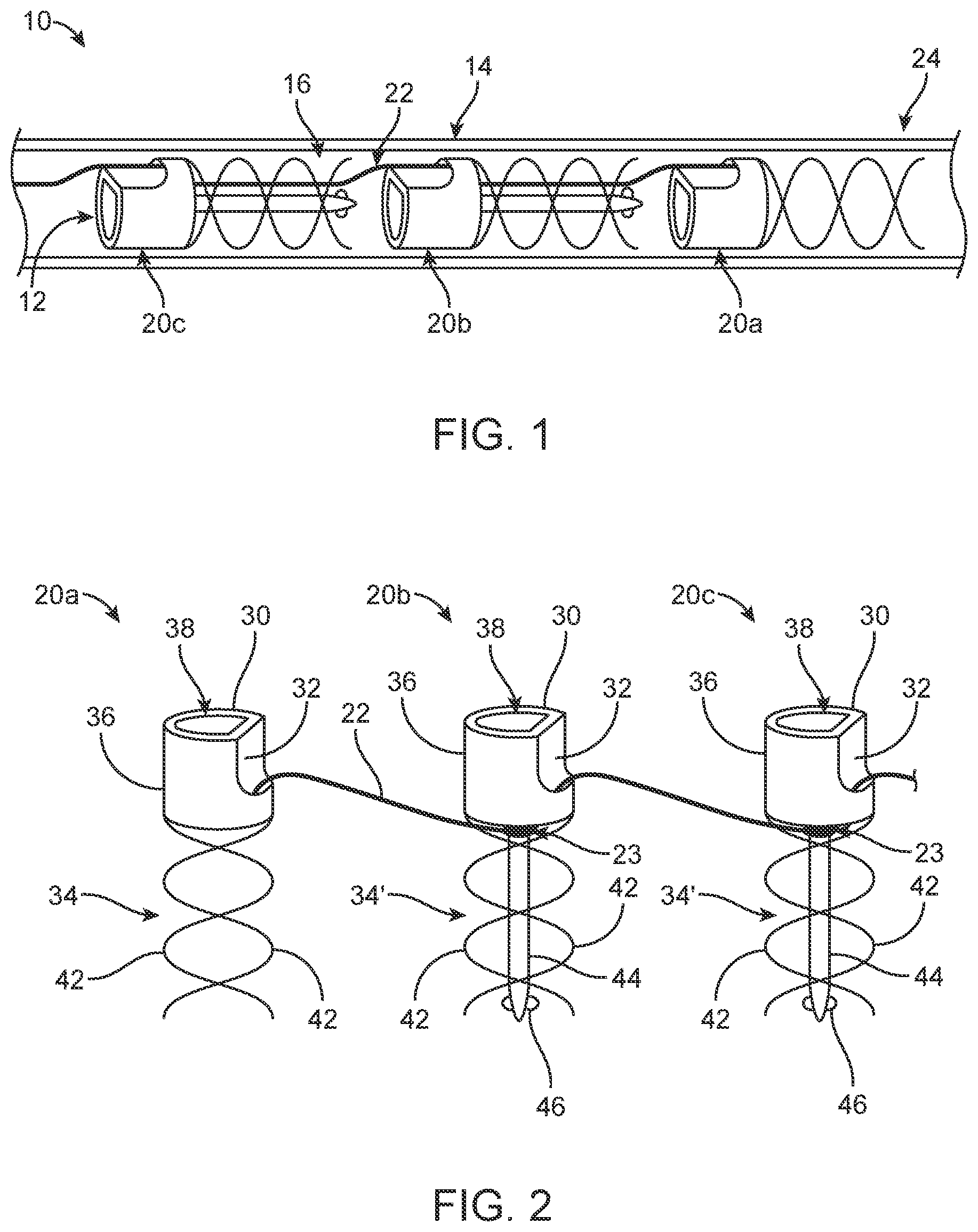 Patent US12396854 Figure 1 – Systems, devices and methods for reshaping a bodily lumen