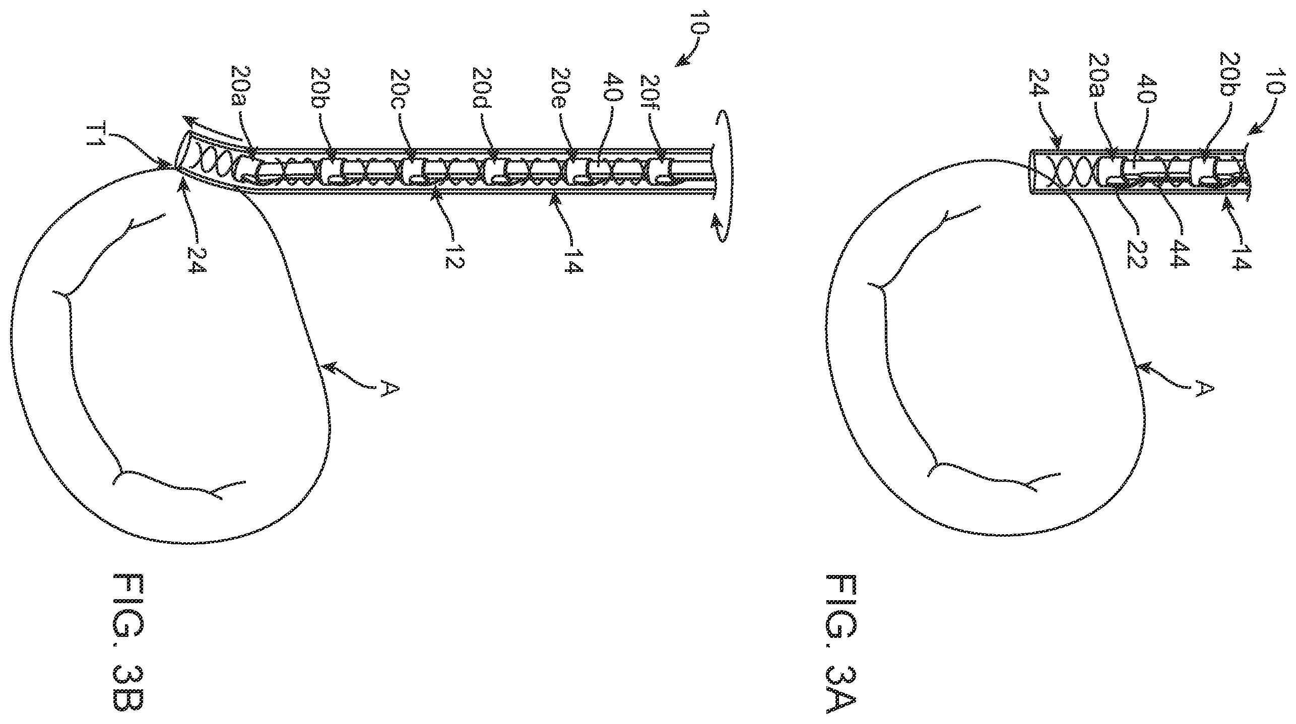 Patent US12396854 Figure 2 – Systems, devices and methods for reshaping a bodily lumen