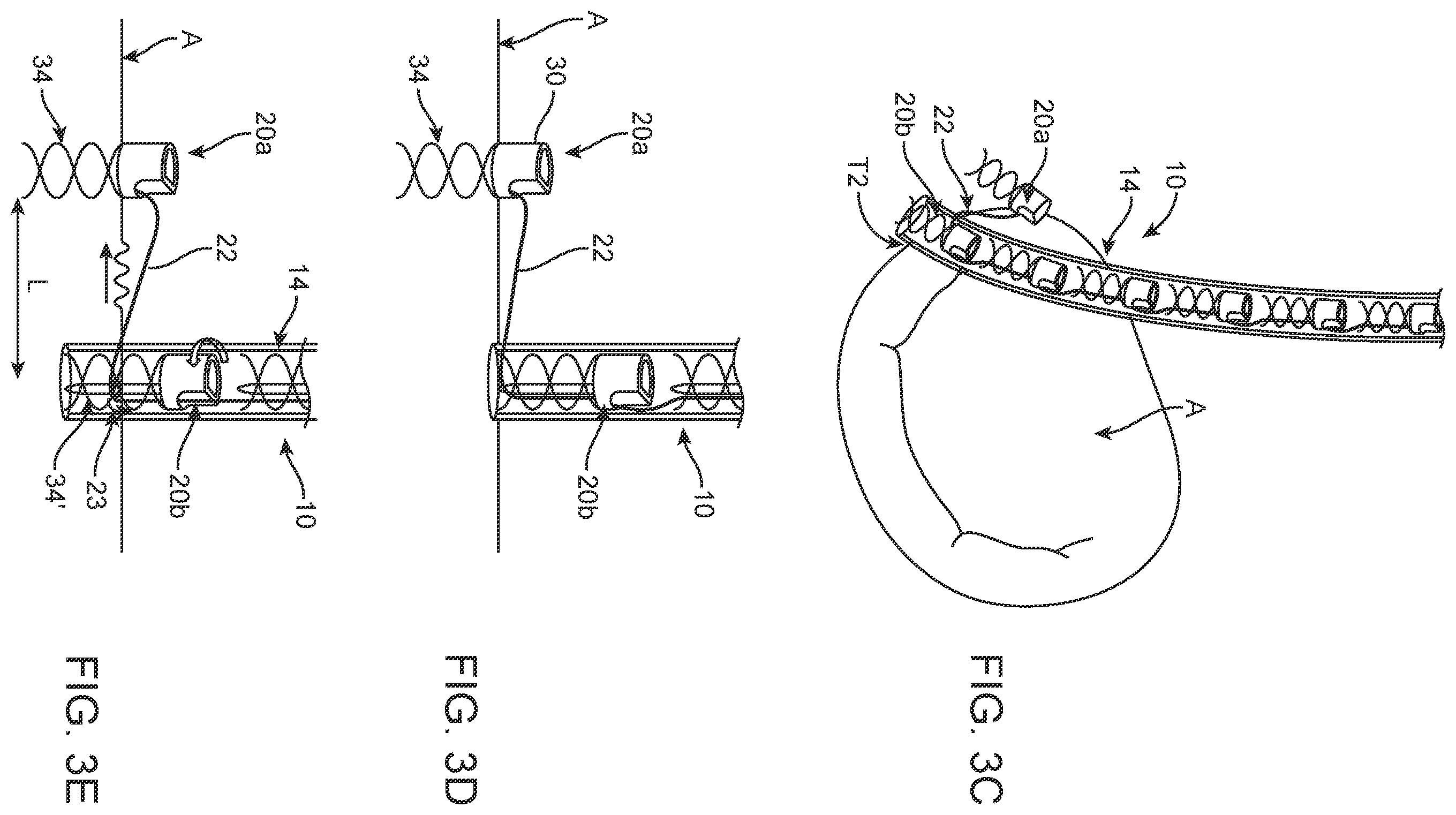 Patent US12396854 Figure 3 – Systems, devices and methods for reshaping a bodily lumen