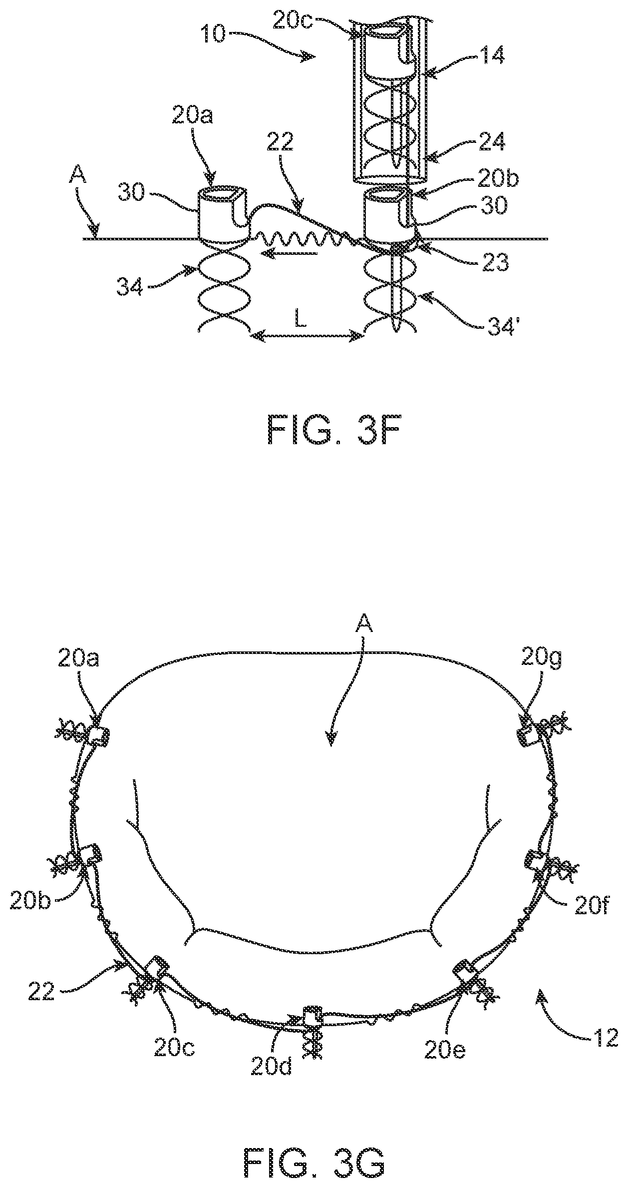 Patent US12396854 Figure 4 – Systems, devices and methods for reshaping a bodily lumen