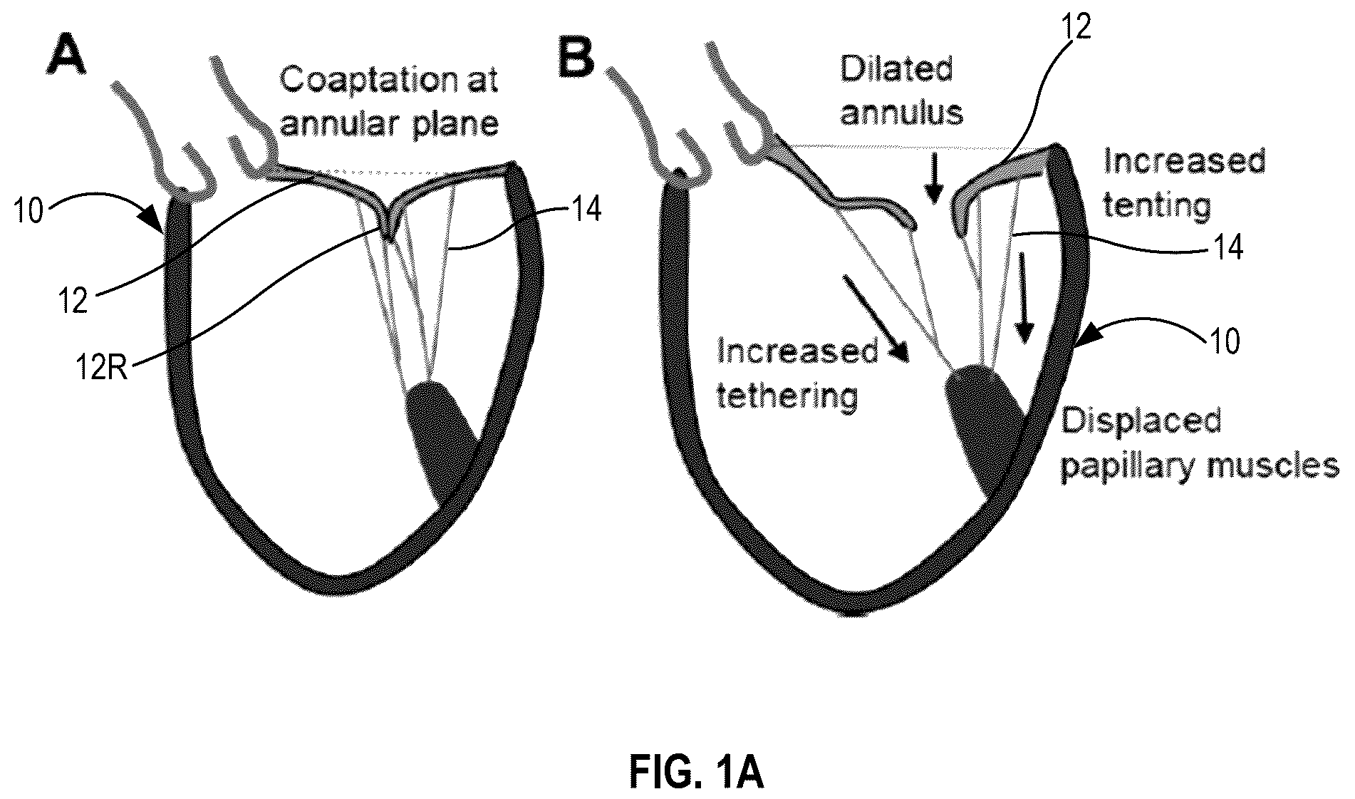 Patent US12396855 Figure 1 – Systems, devices, and methods for reducing heart valve regurgitation