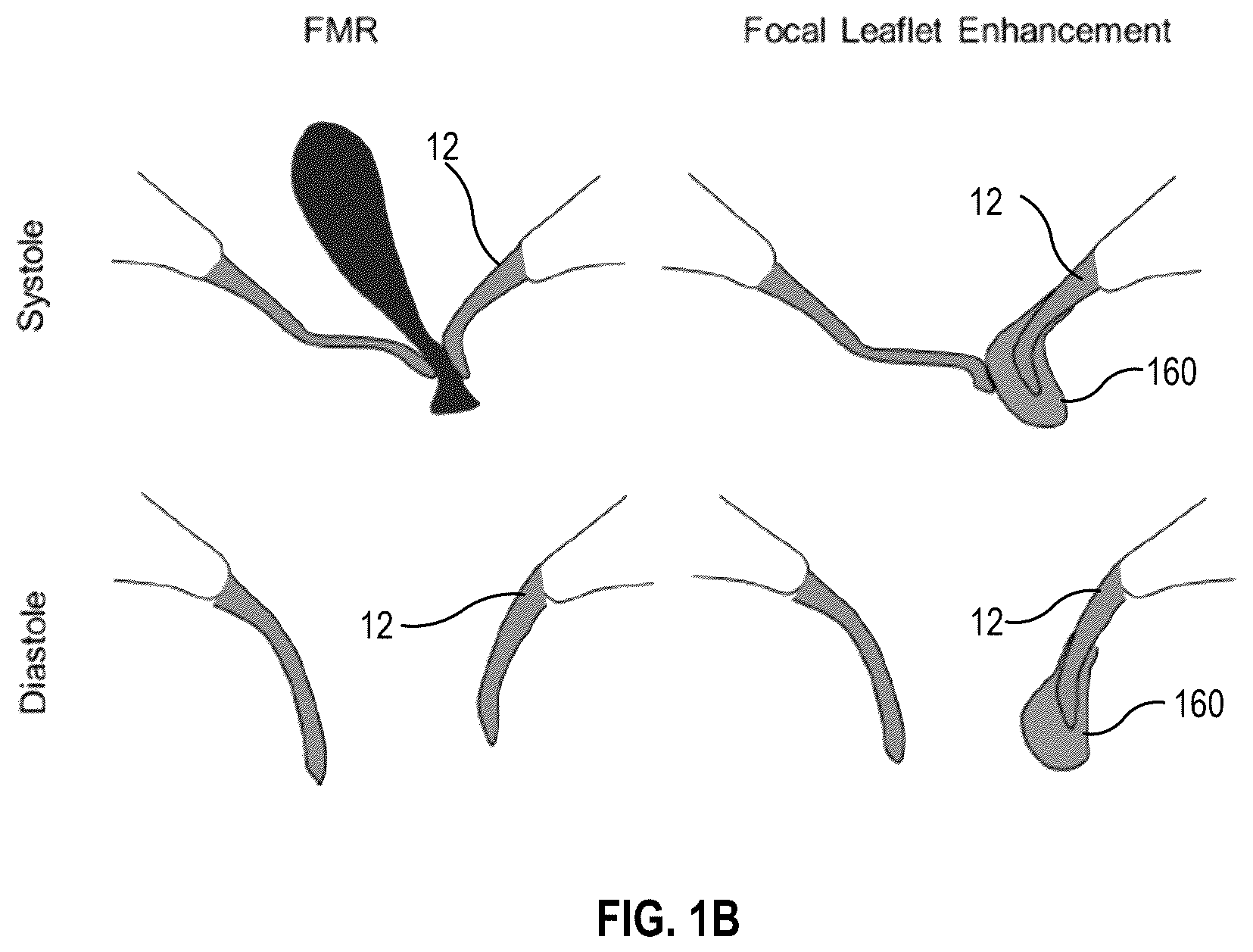 Patent US12396855 Figure 2 – Systems, devices, and methods for reducing heart valve regurgitation