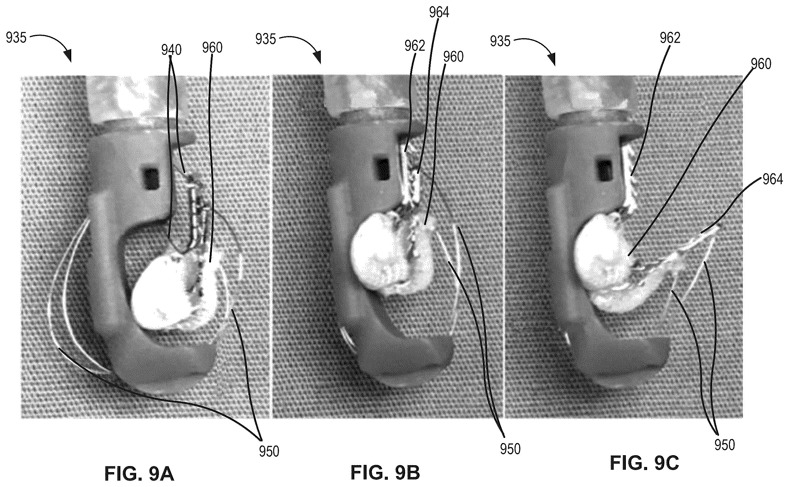 Patent US12396855 Figure 12 – Systems, devices, and methods for reducing heart valve regurgitation