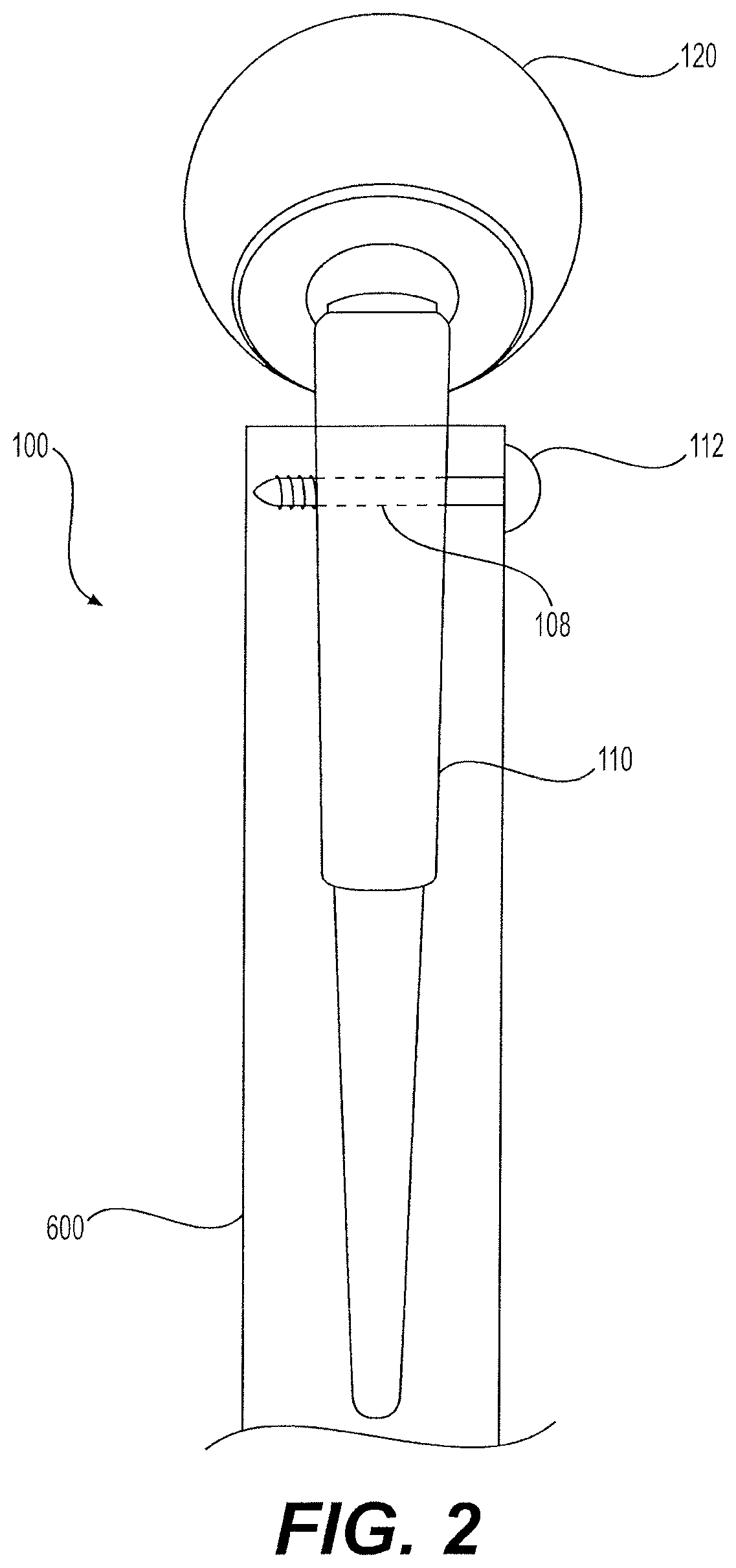 Patent US12396857 Figure 2 – Proximally fitting femoral component with adjunctive screw fixation