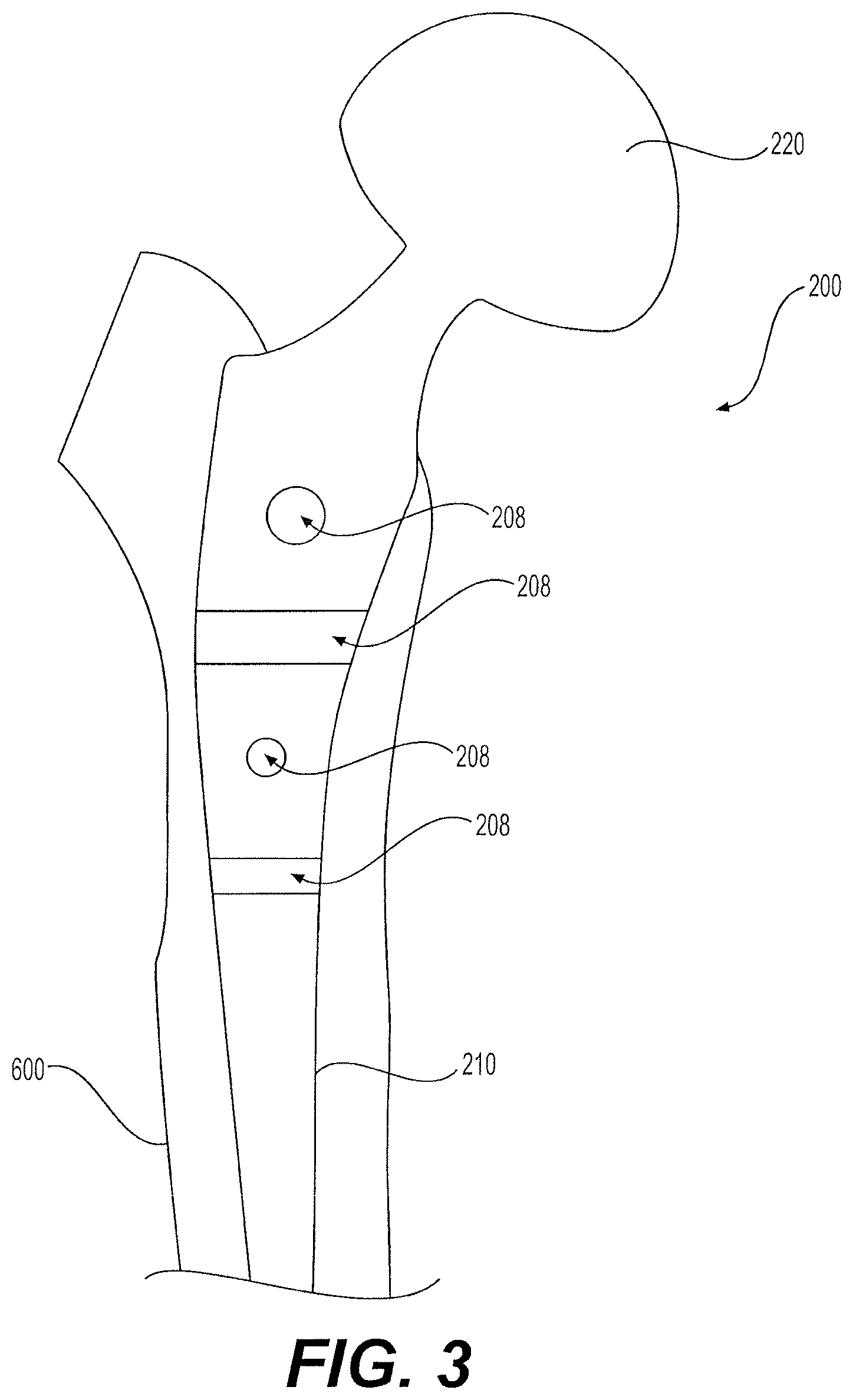 Patent US12396857 Figure 3 – Proximally fitting femoral component with adjunctive screw fixation