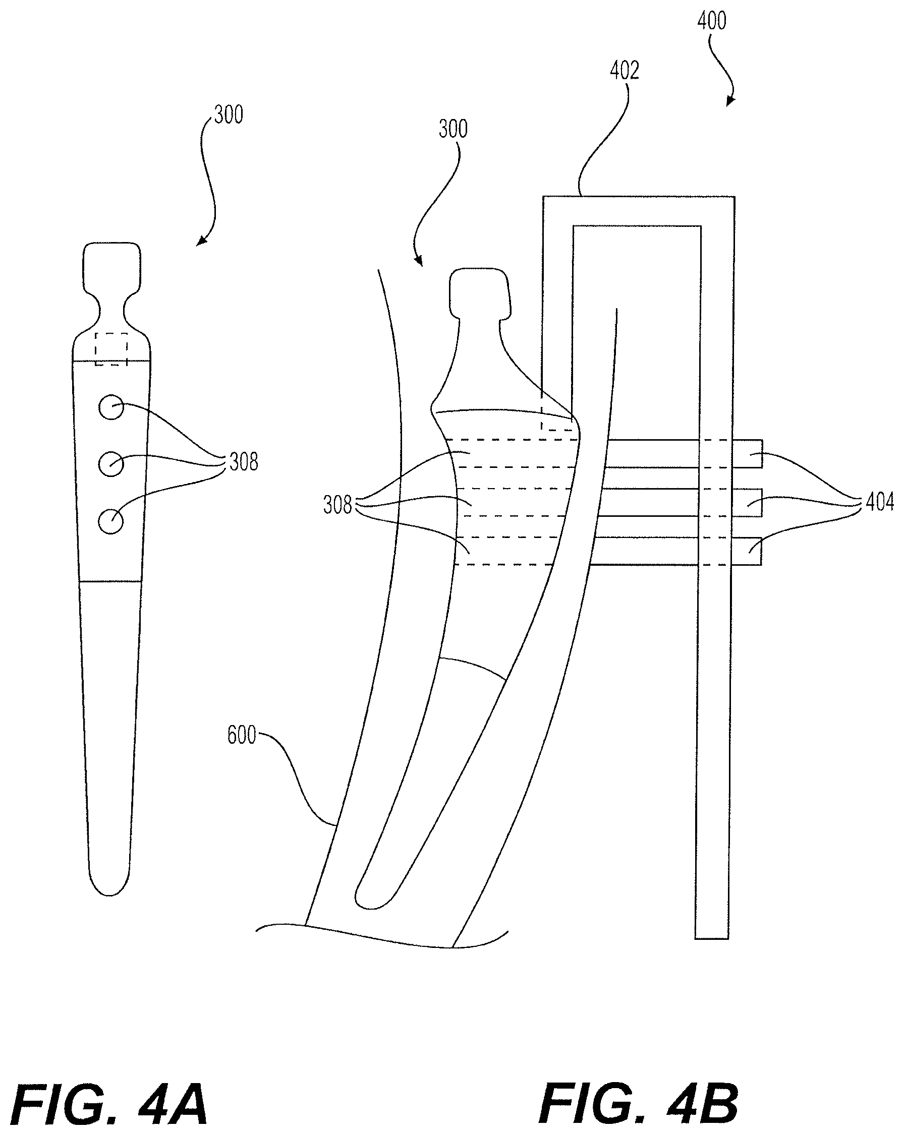 Patent US12396857 Figure 4 – Proximally fitting femoral component with adjunctive screw fixation