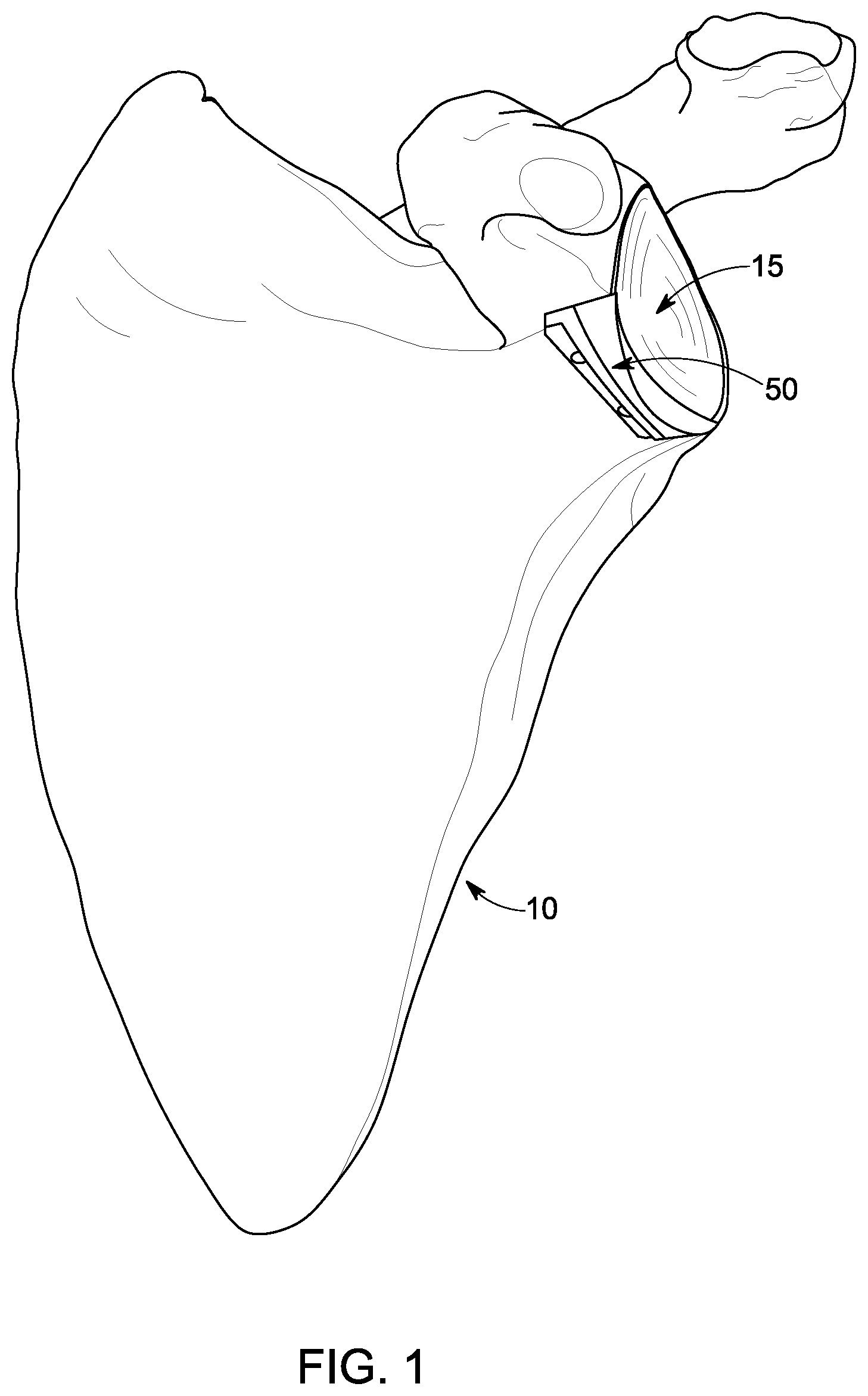Patent US12396861 Figure 1 – Implant systems for repair of a glenoid cavity