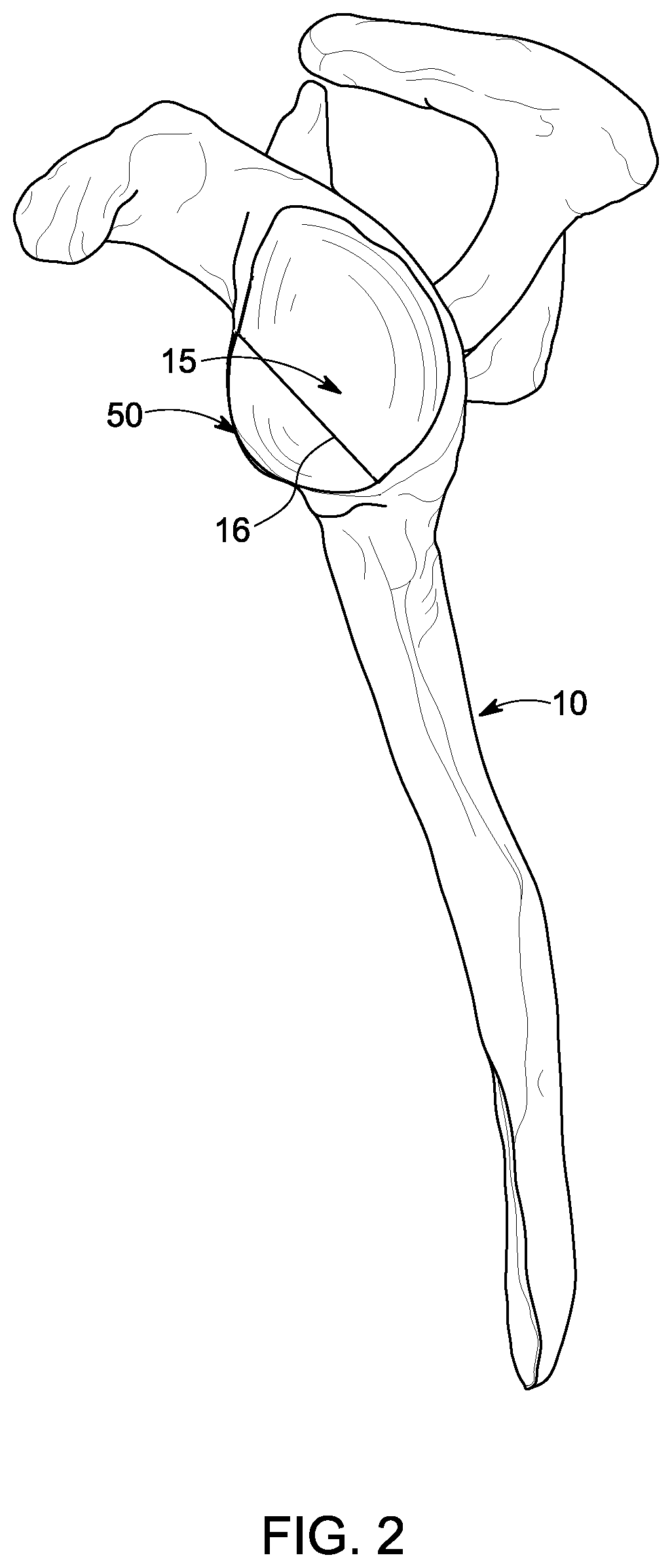 Patent US12396861 Figure 2 – Implant systems for repair of a glenoid cavity