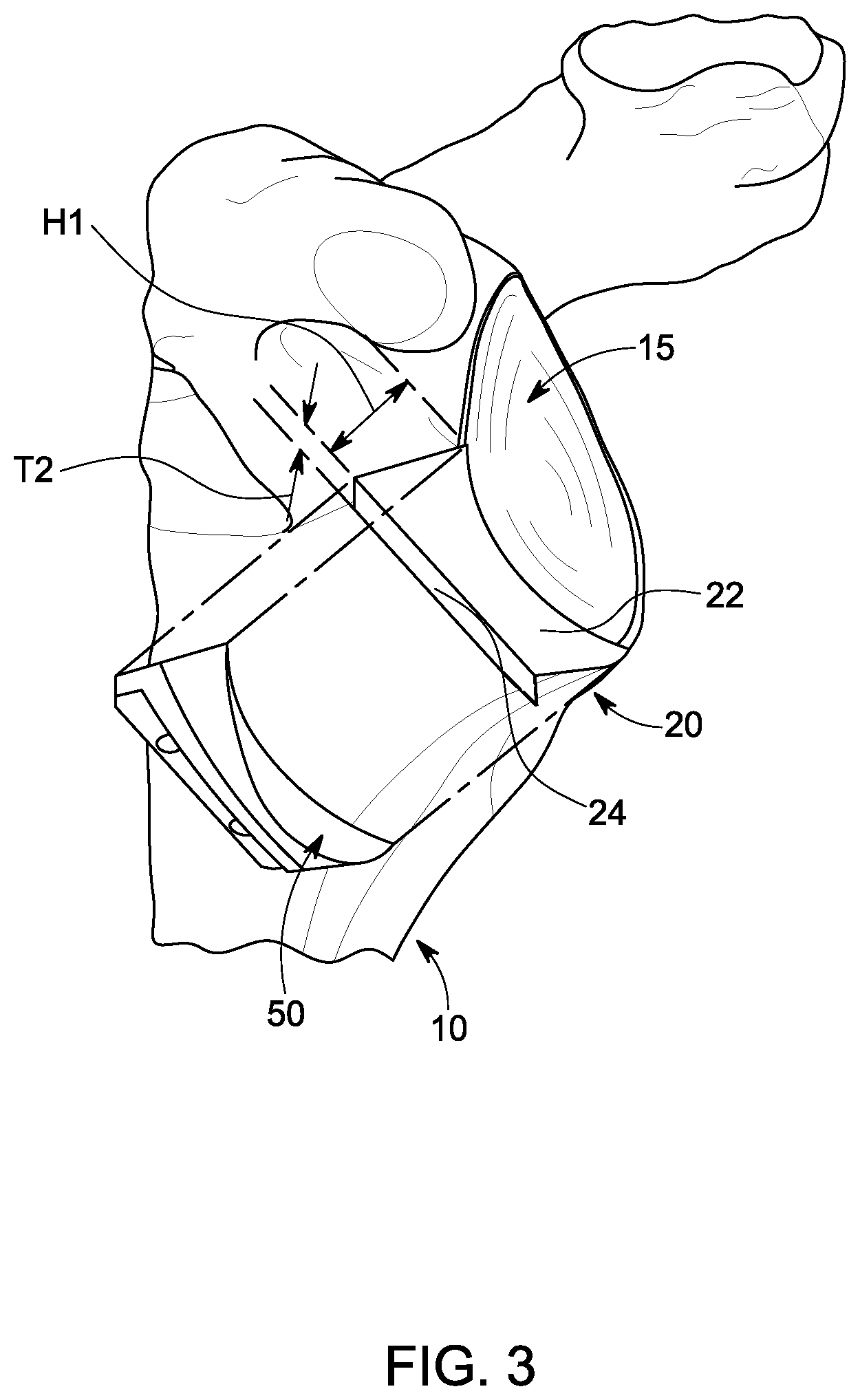 Patent US12396861 Figure 3 – Implant systems for repair of a glenoid cavity