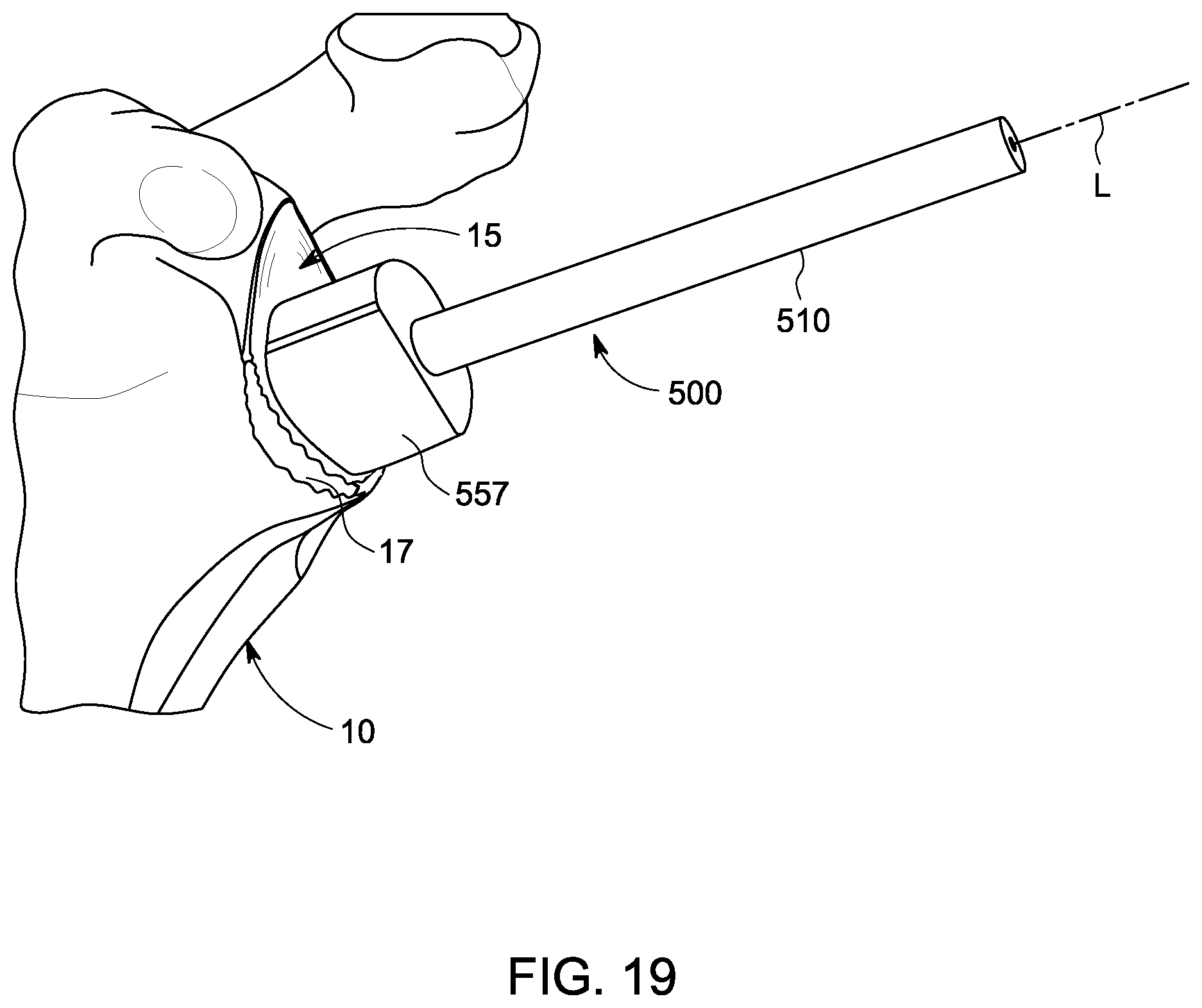 Patent US12396861 Figure 9 – Implant systems for repair of a glenoid cavity