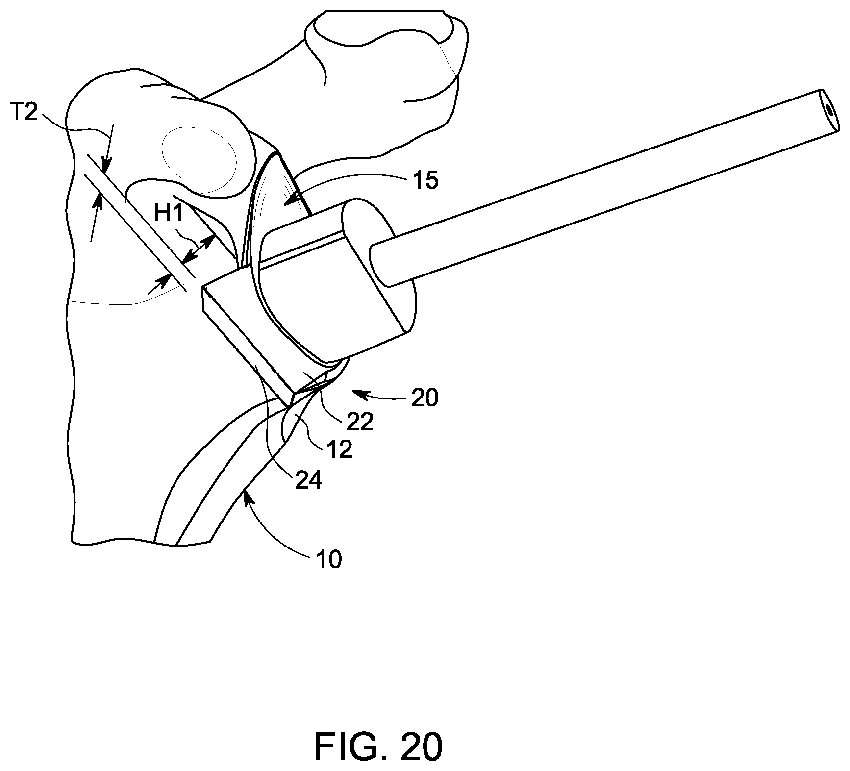 Patent US12396861 Figure 10 – Implant systems for repair of a glenoid cavity