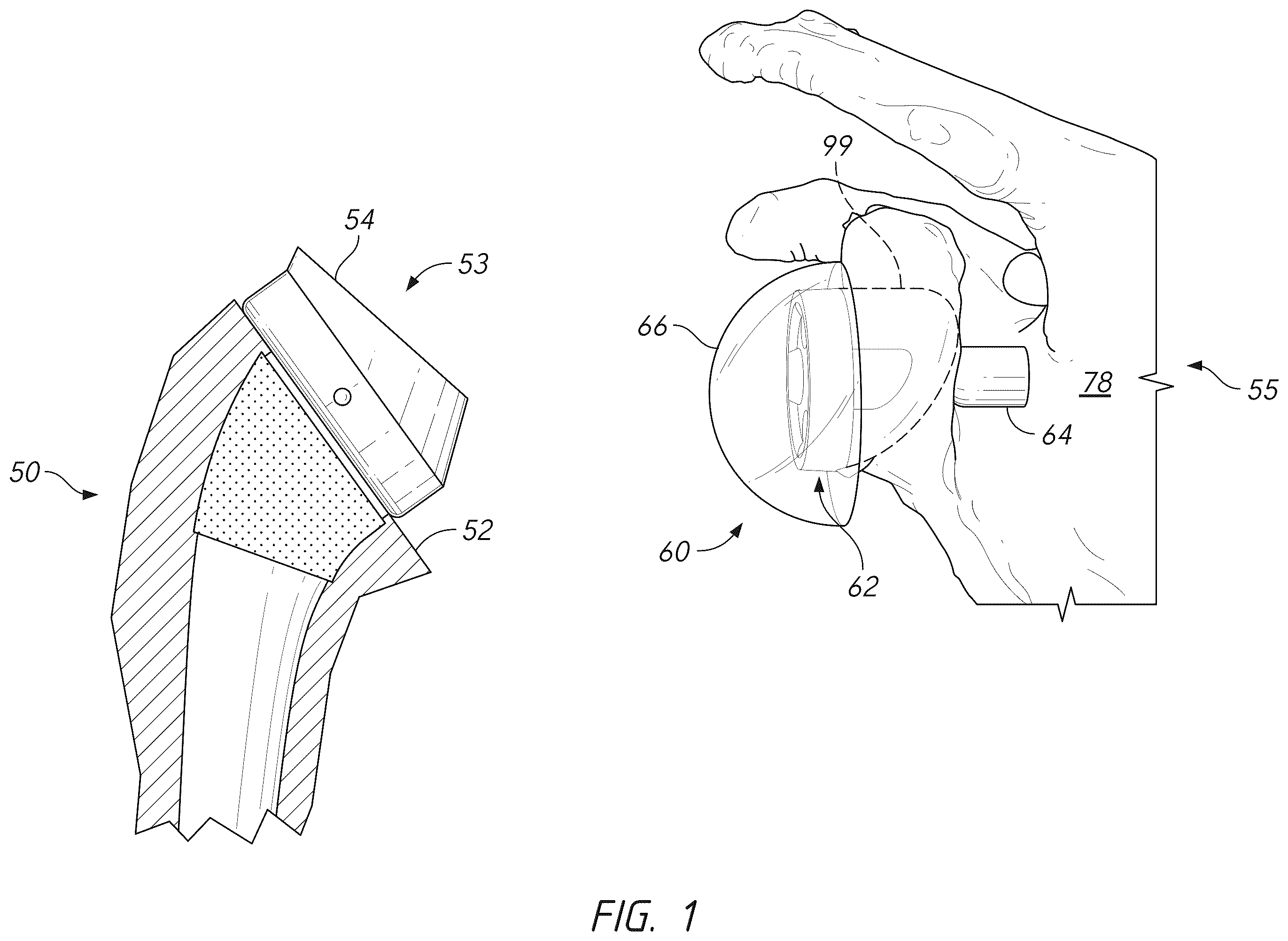 Patent US12396862 Figure 1 – Glenoid baseplate and implant assemblies
