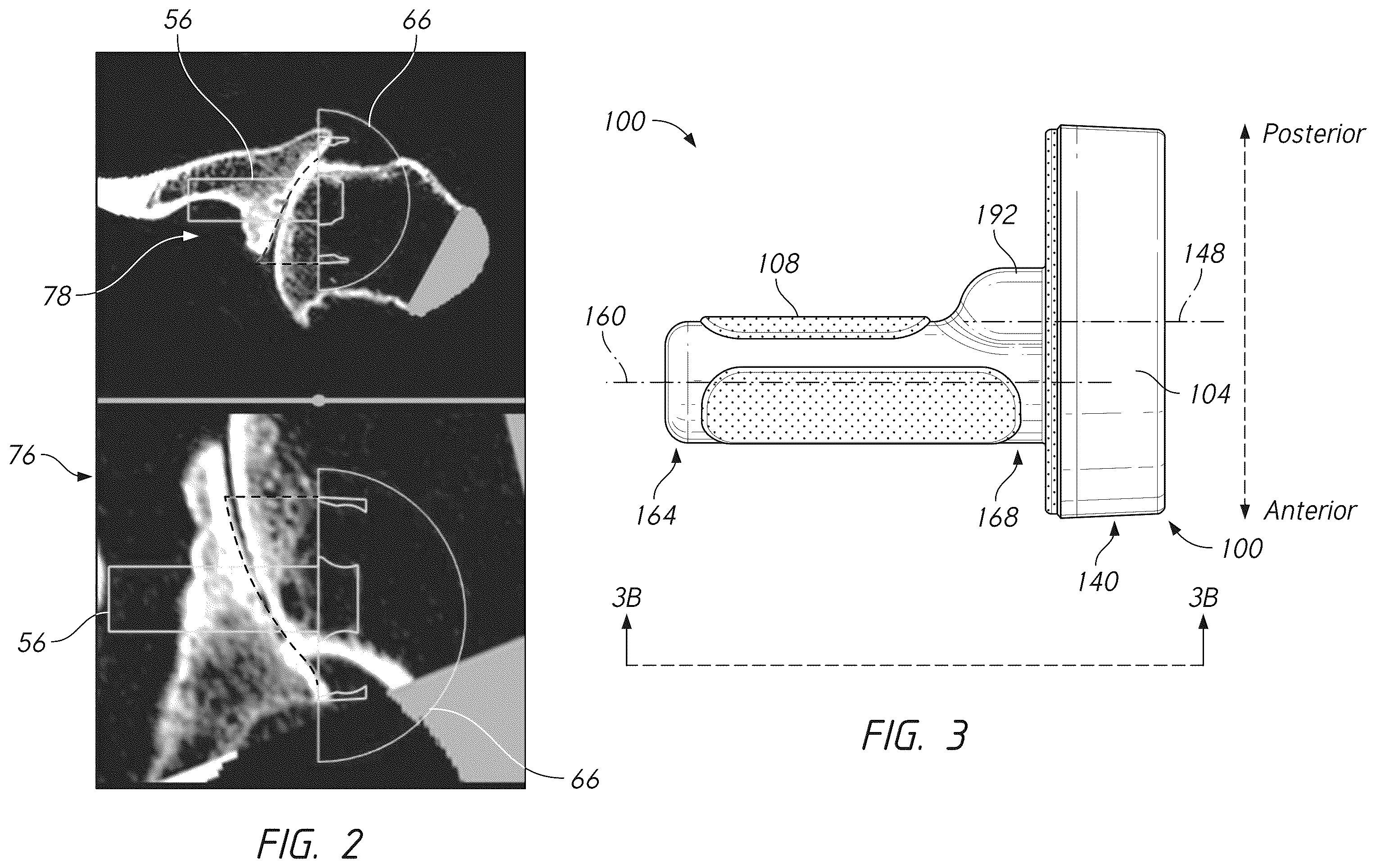 Patent US12396862 Figure 5 – Glenoid baseplate and implant assemblies