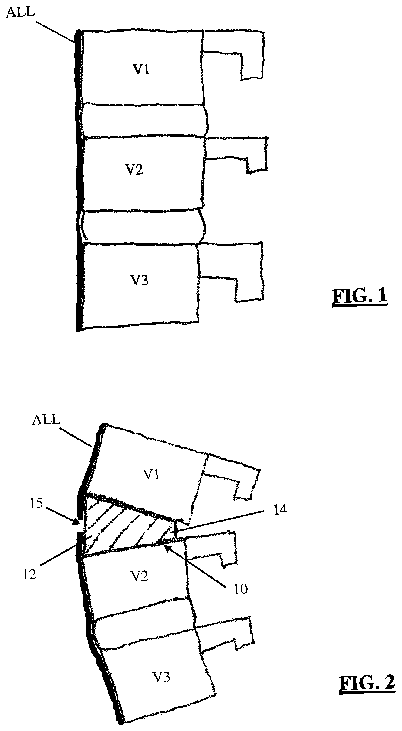 Patent US12396863 Figure 1 – Methods and apparatus for performing spine surgery