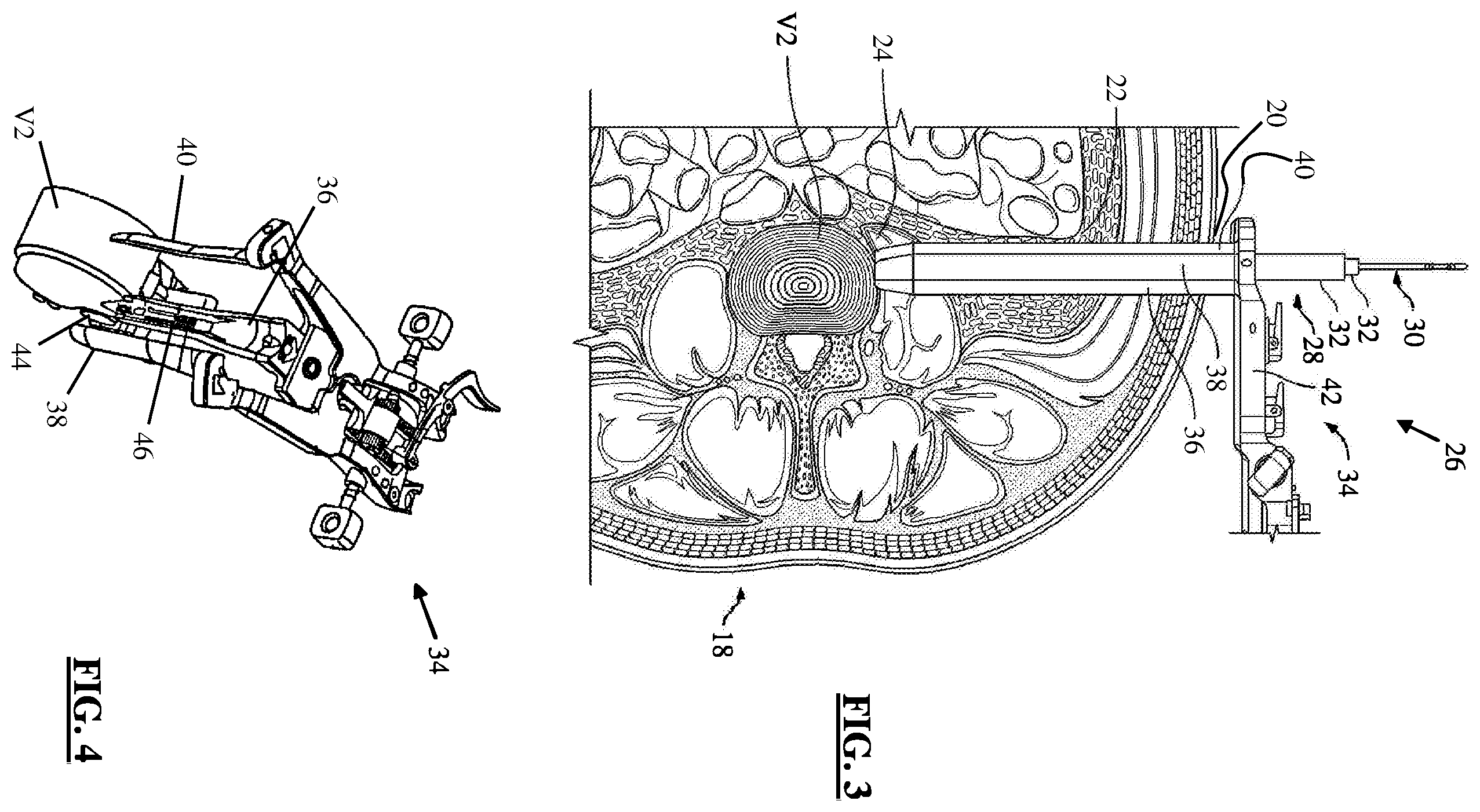 Patent US12396863 Figure 2 – Methods and apparatus for performing spine surgery