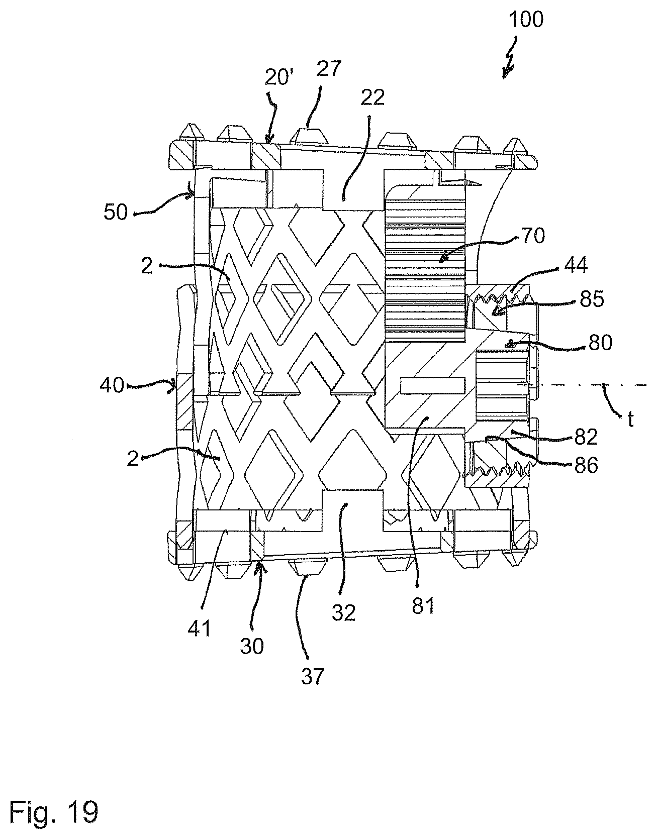 Patent US12396864 Figure 7 – Implant for engagement between vertebrae, and implant kit