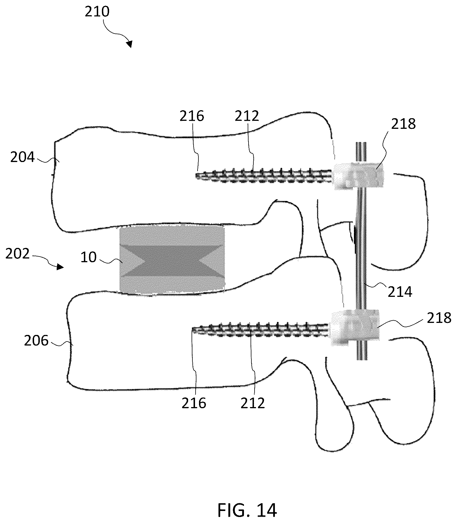 Patent US12396867 Figure 13 – Expandable footprint implant