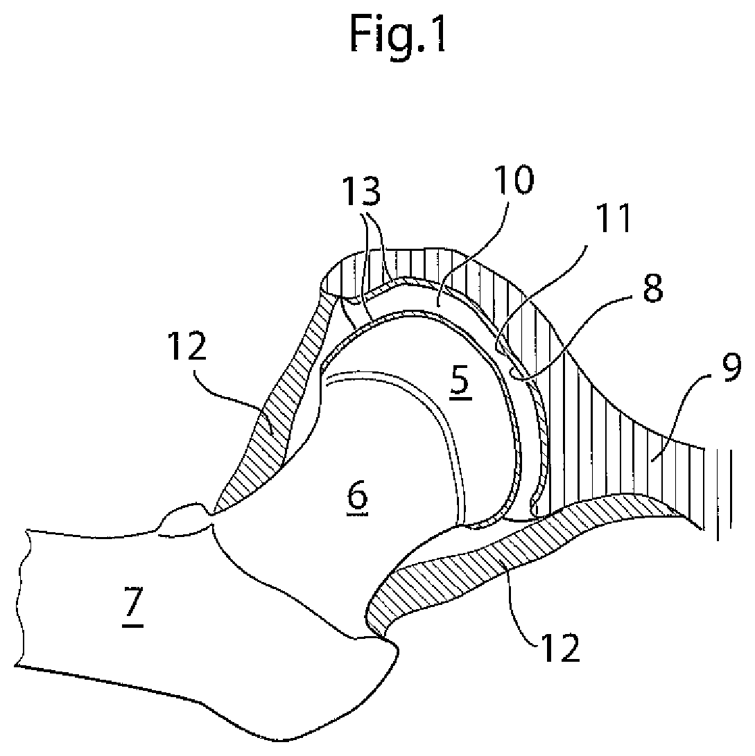 Patent US12396868 Figure 1 – Hip joint instrument and method