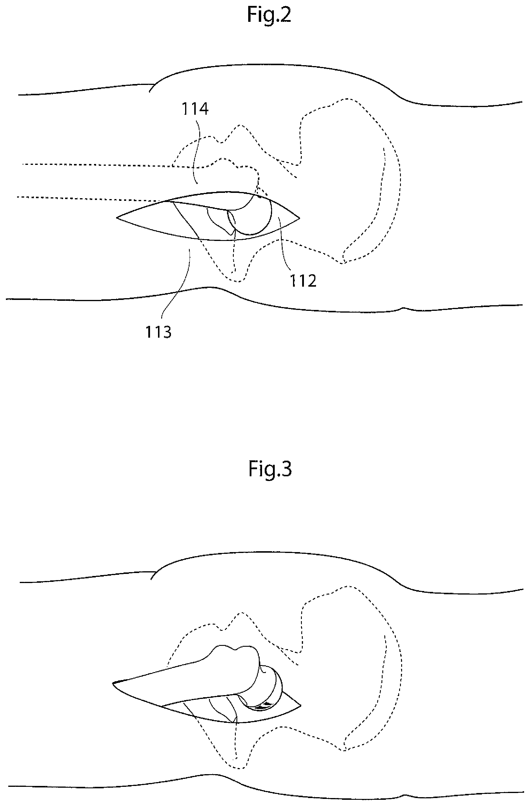Patent US12396868 Figure 2 – Hip joint instrument and method