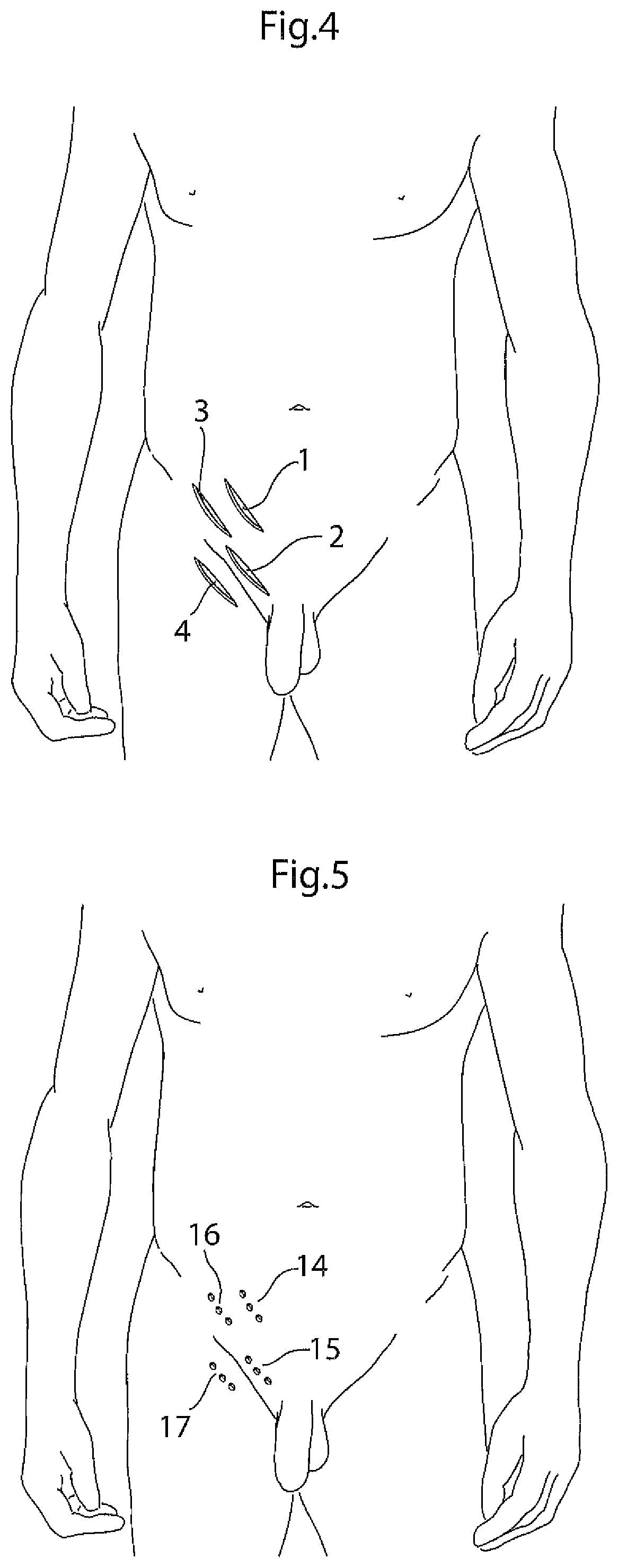 Patent US12396868 Figure 3 – Hip joint instrument and method