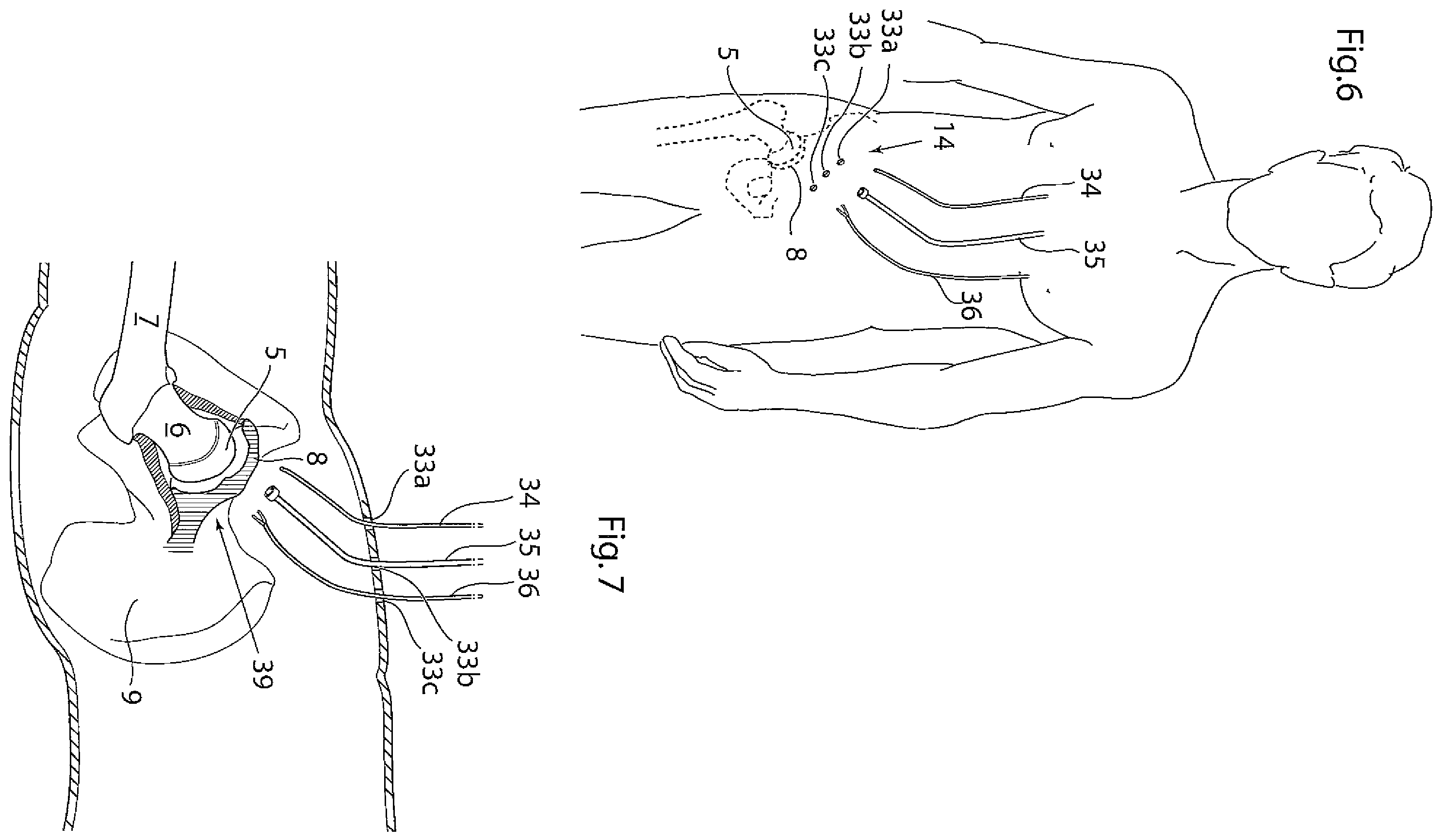 Patent US12396868 Figure 4 – Hip joint instrument and method