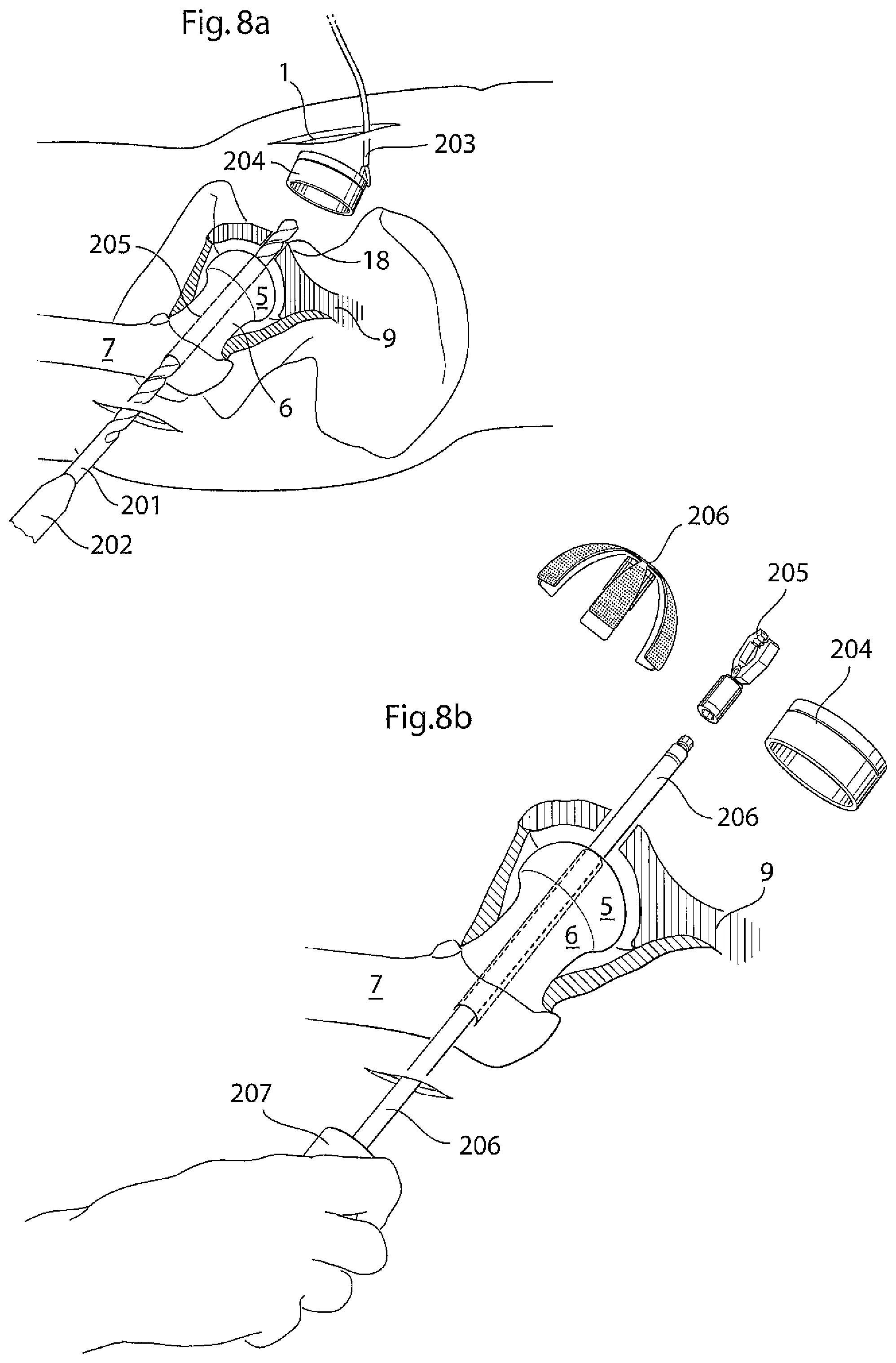 Patent US12396868 Figure 5 – Hip joint instrument and method