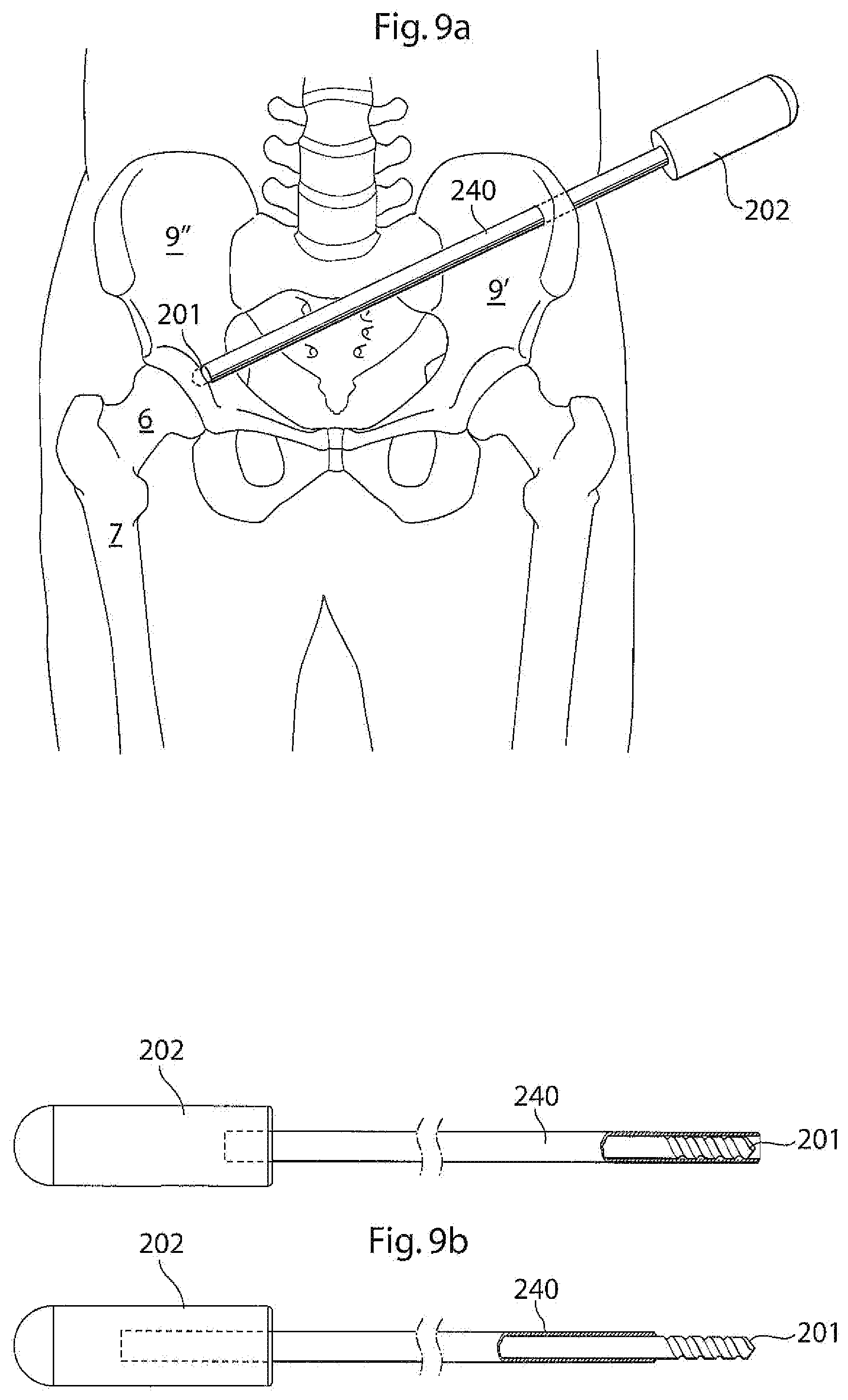 Patent US12396868 Figure 6 – Hip joint instrument and method
