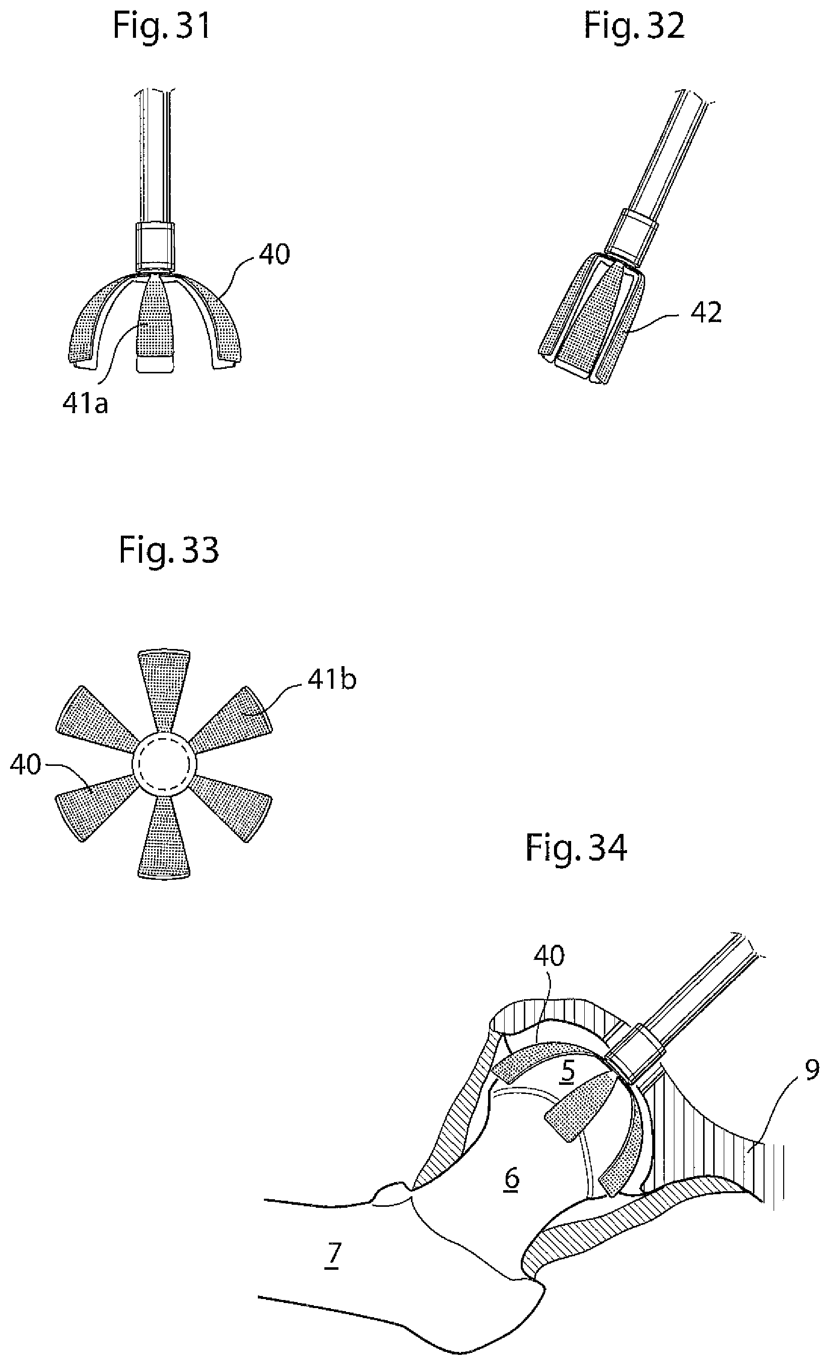 Patent US12396868 Figure 13 – Hip joint instrument and method