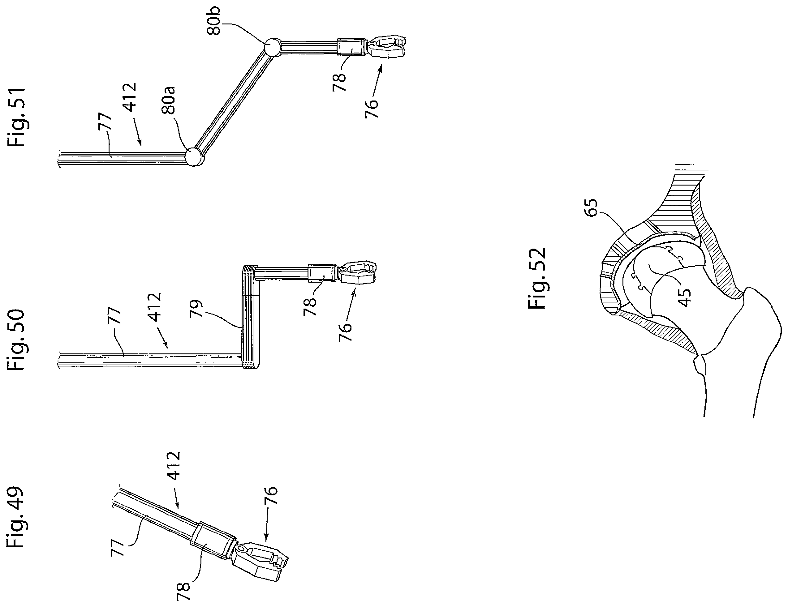 Patent US12396868 Figure 18 – Hip joint instrument and method