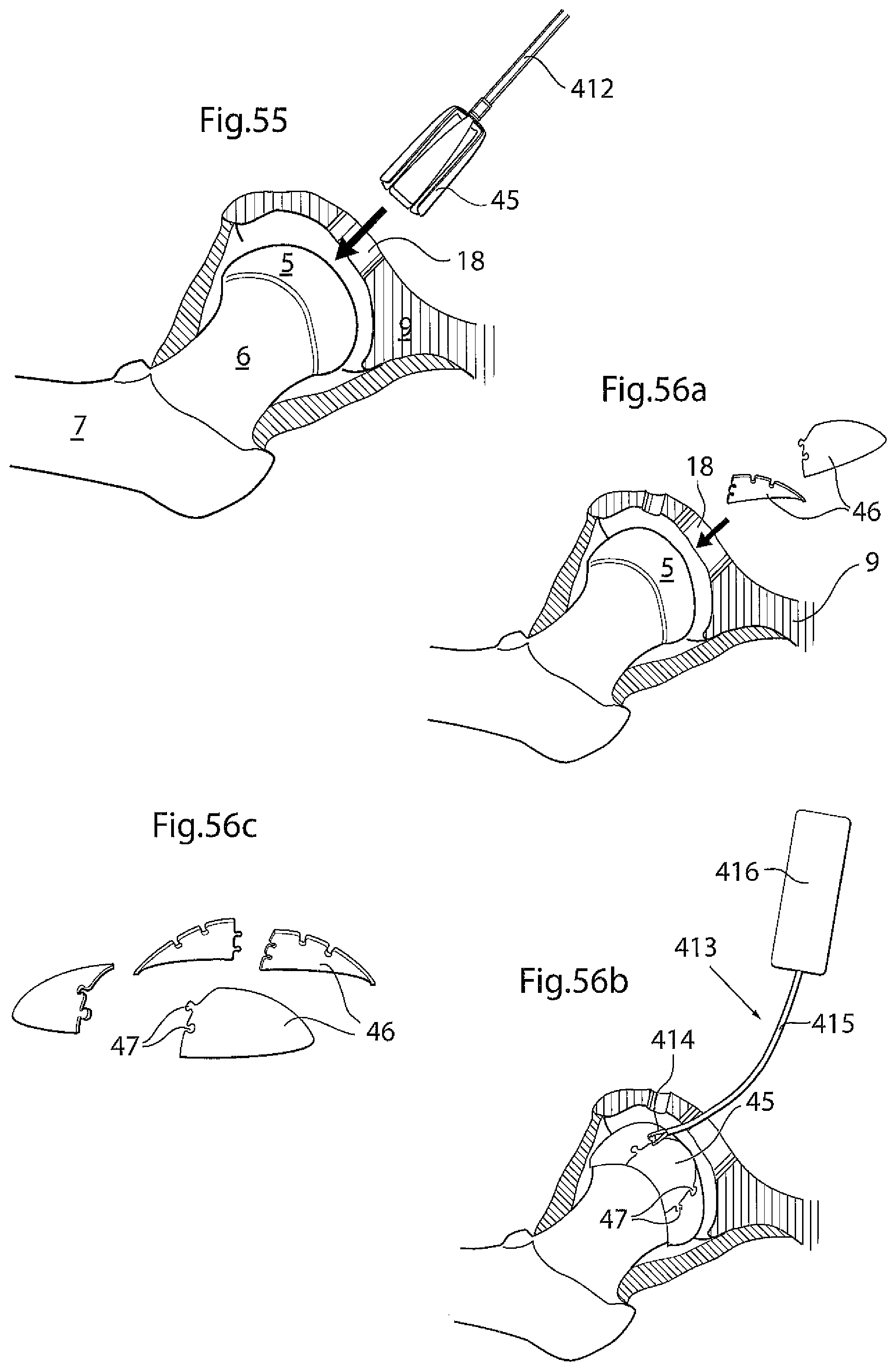 Patent US12396868 Figure 20 – Hip joint instrument and method